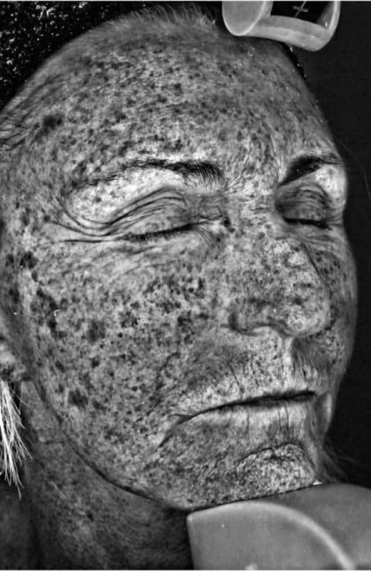 Before rosacea treatment