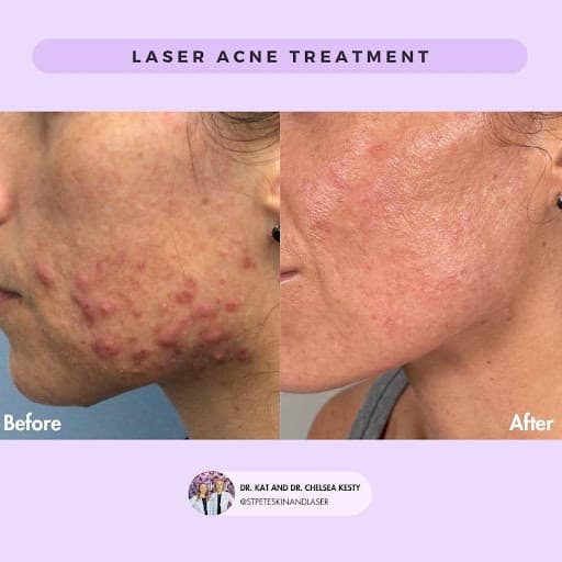 Laser resurfacing for crepey skin around eyes