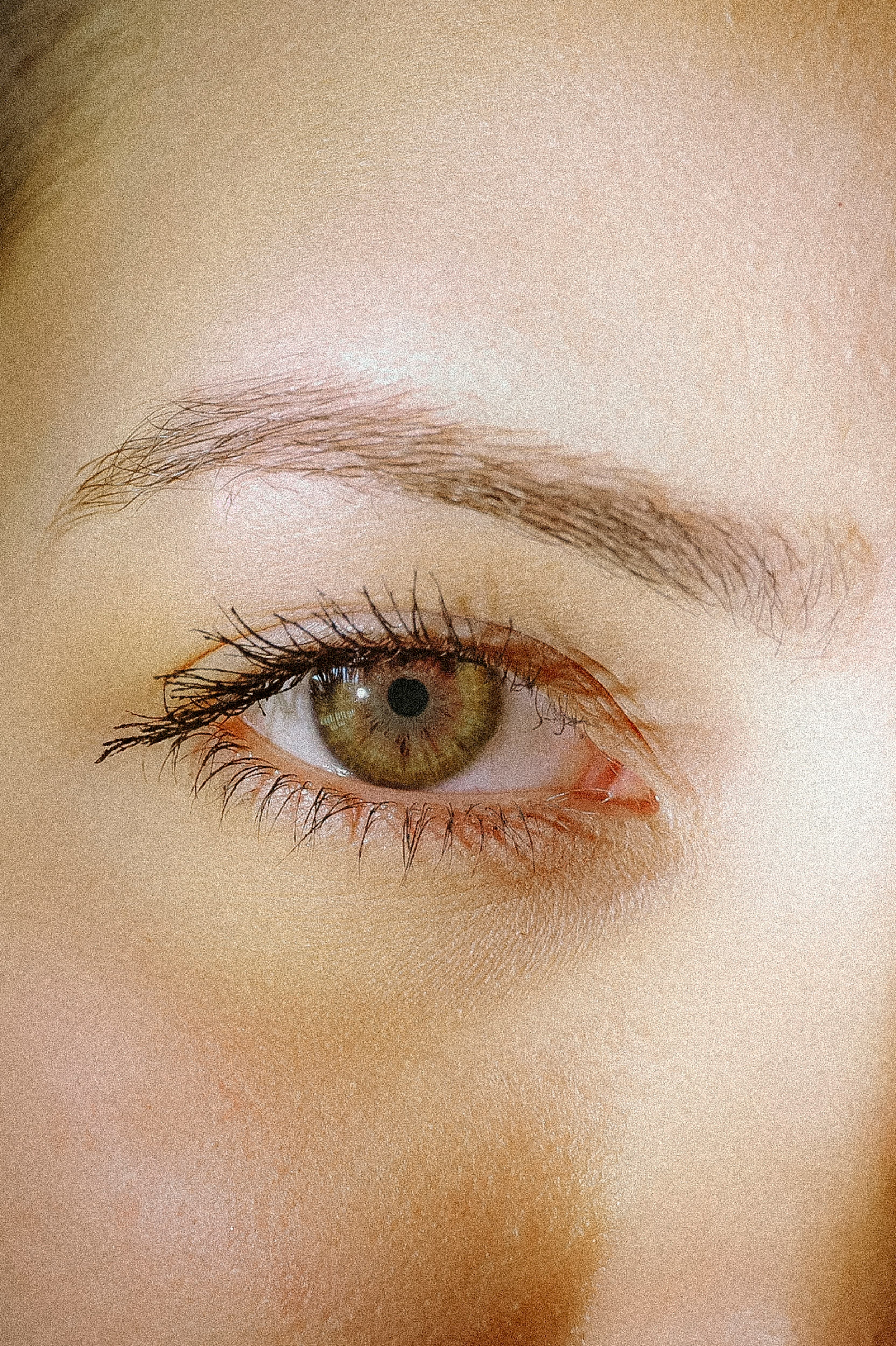 Laser blepharoplasty vs surgical guide