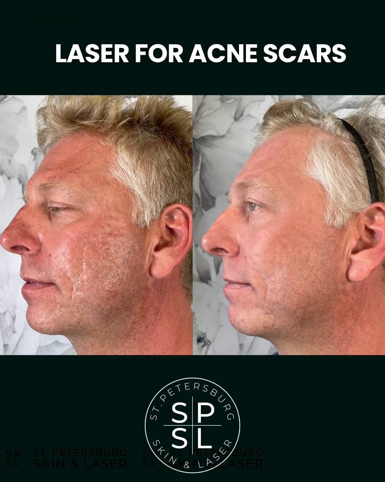 Acne Scar Laser before and after results
