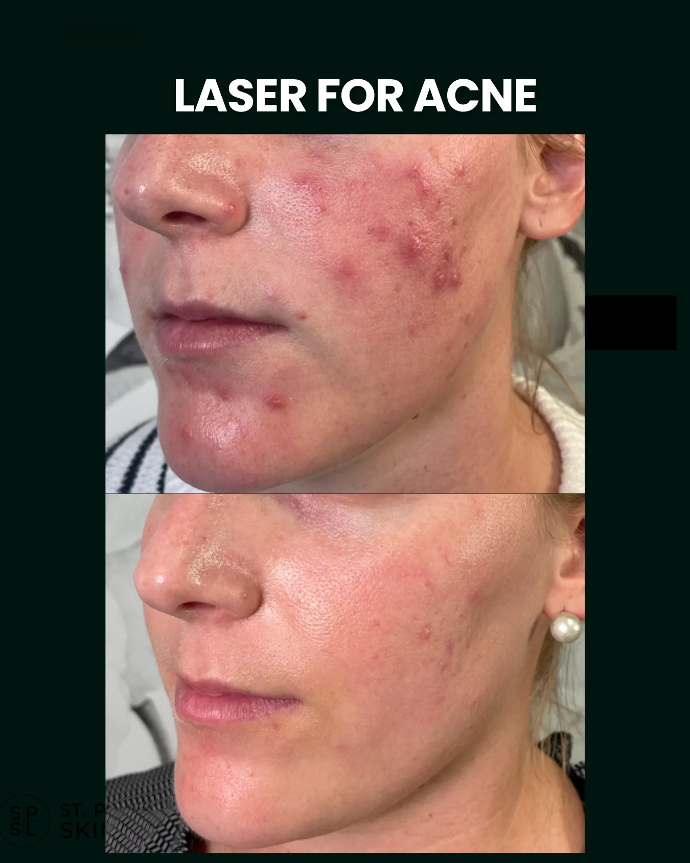 Acne Scar Laser before and after results