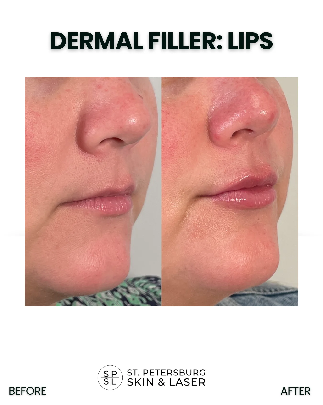 Dermal Fillers before and after results