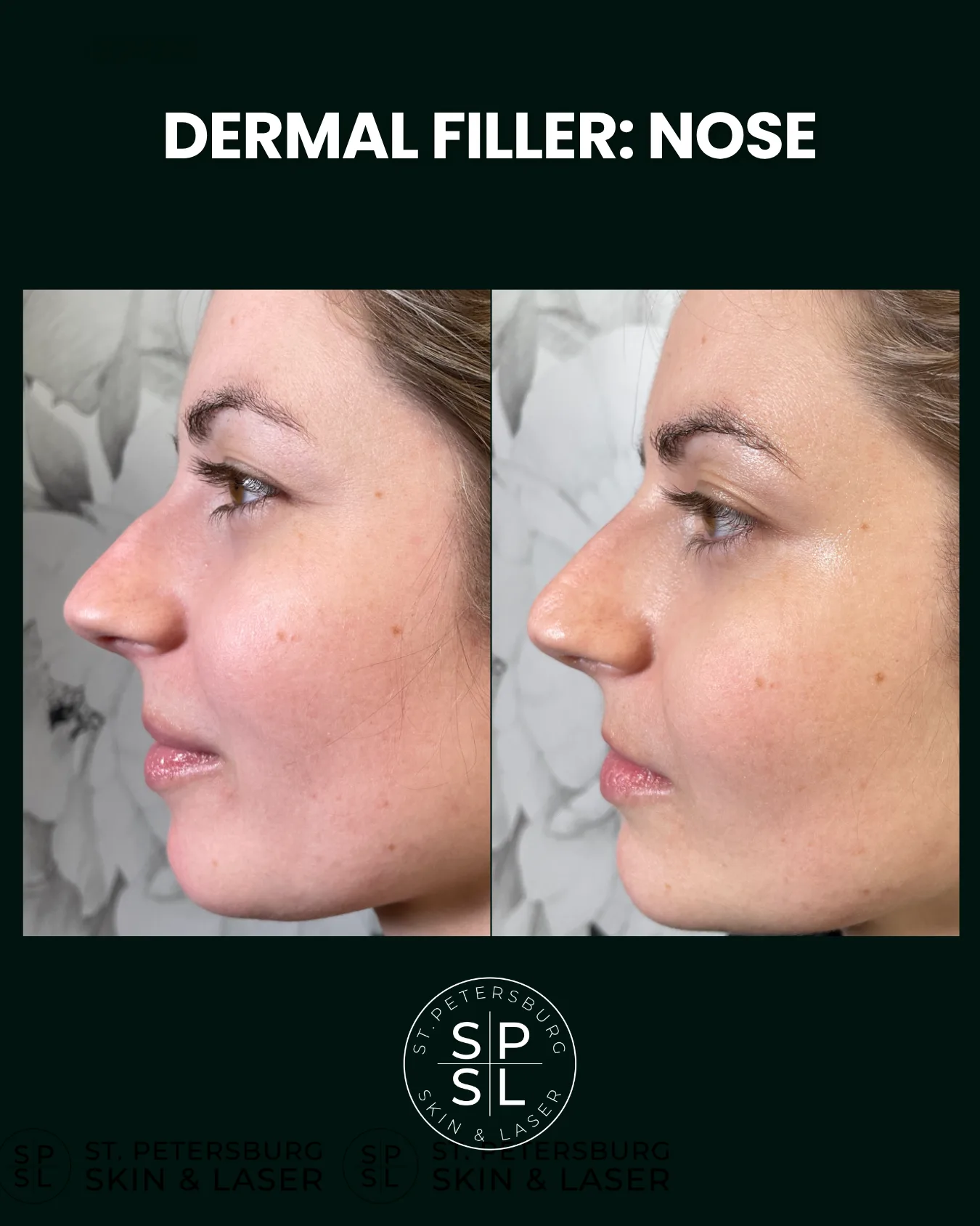 Dermal Fillers before and after results