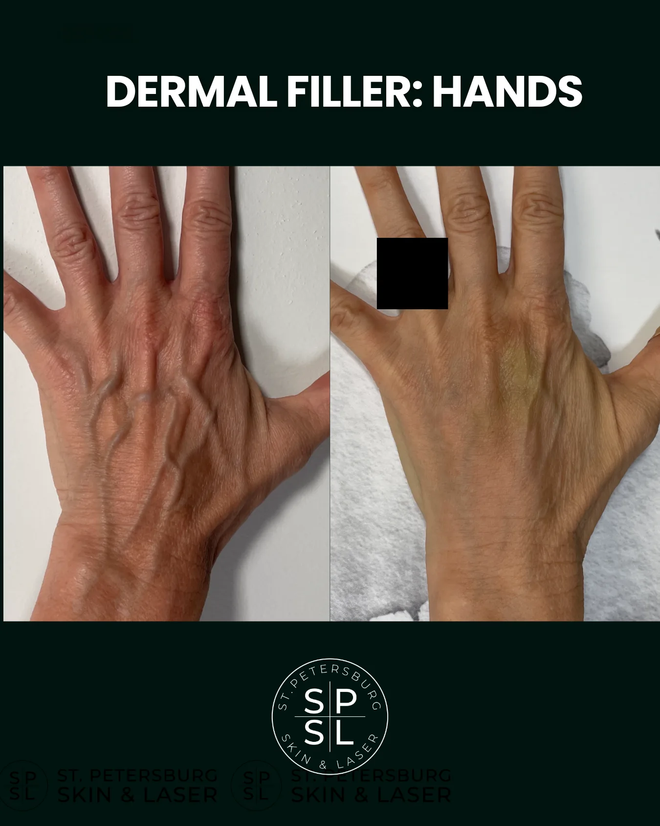 Dermal Fillers before and after results