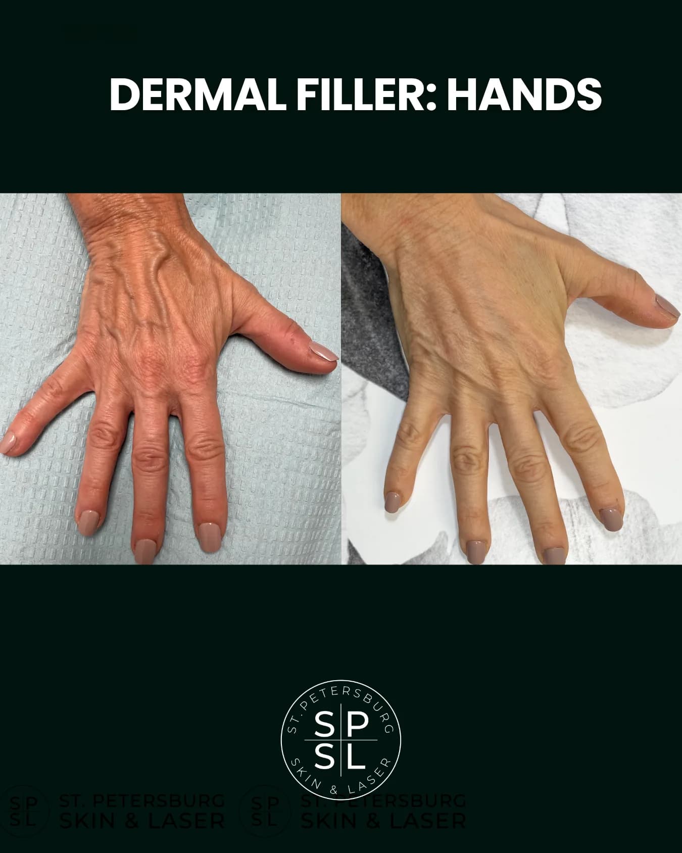 Dermal Fillers before and after results