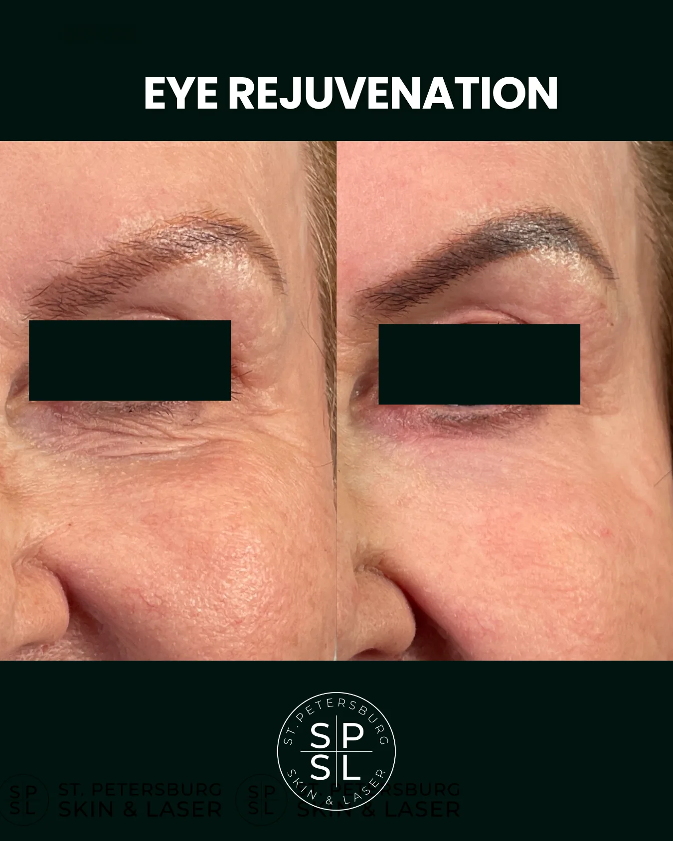 Eye Rejuvenation before and after results