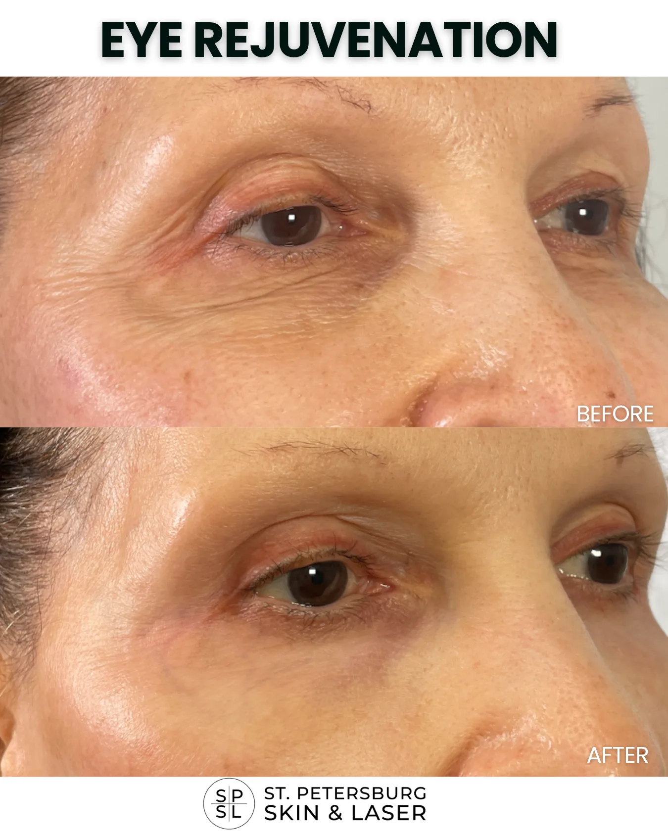 Eye Rejuvenation before and after results