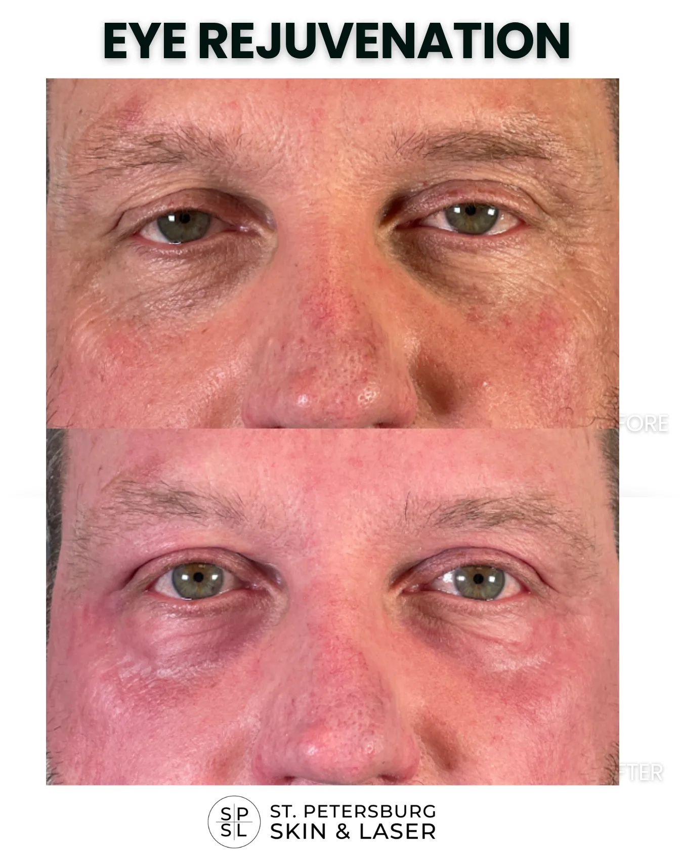 Eye Rejuvenation before and after results