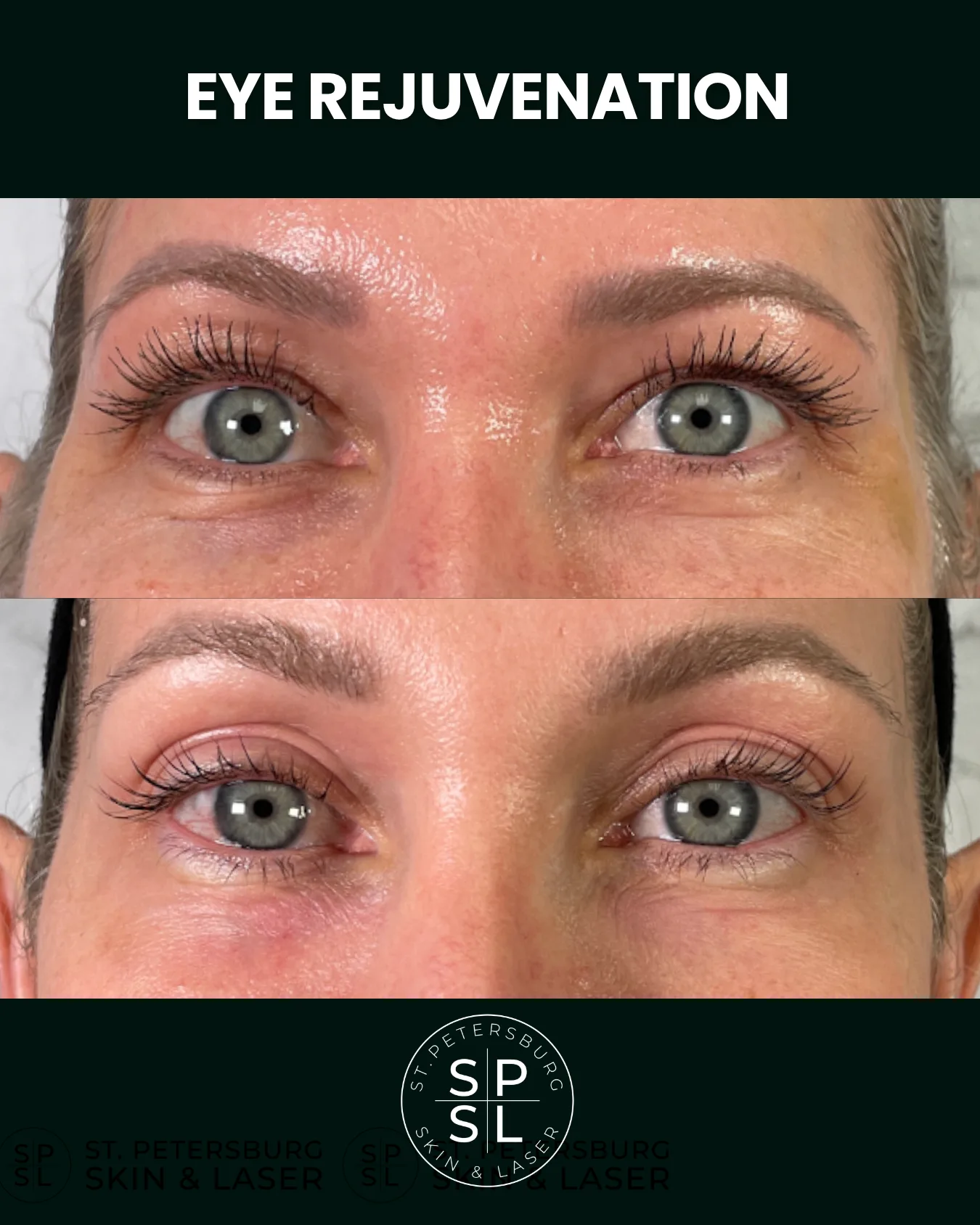 Eye Rejuvenation before and after results