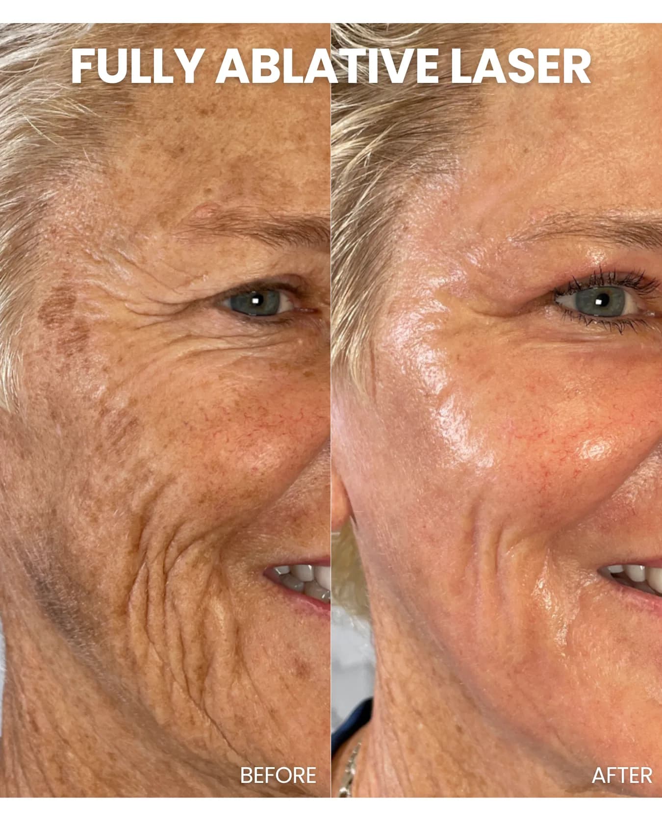 Fully Ablative Laser before and after results
