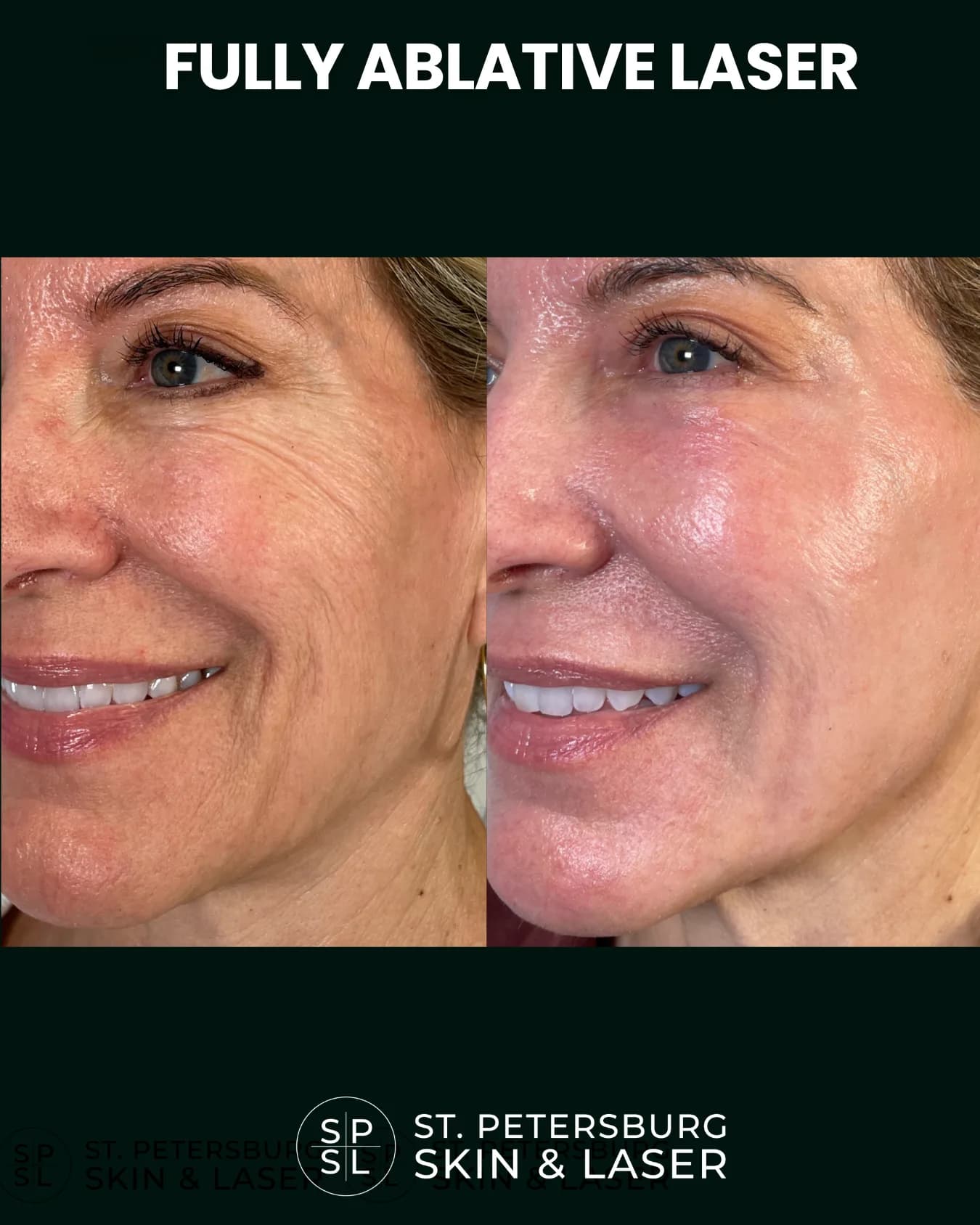 Fully Ablative Laser before and after results