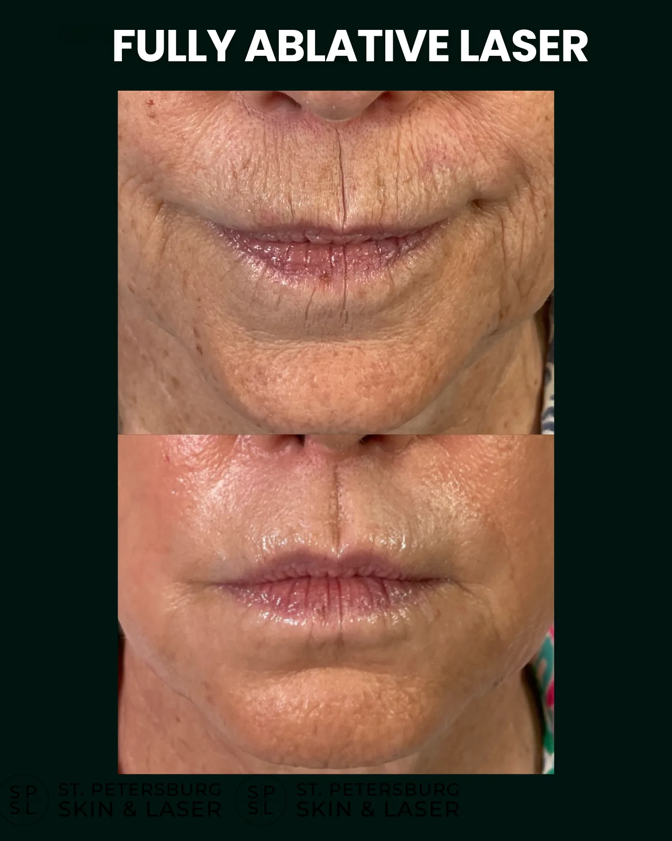 Fully Ablative Laser before and after results