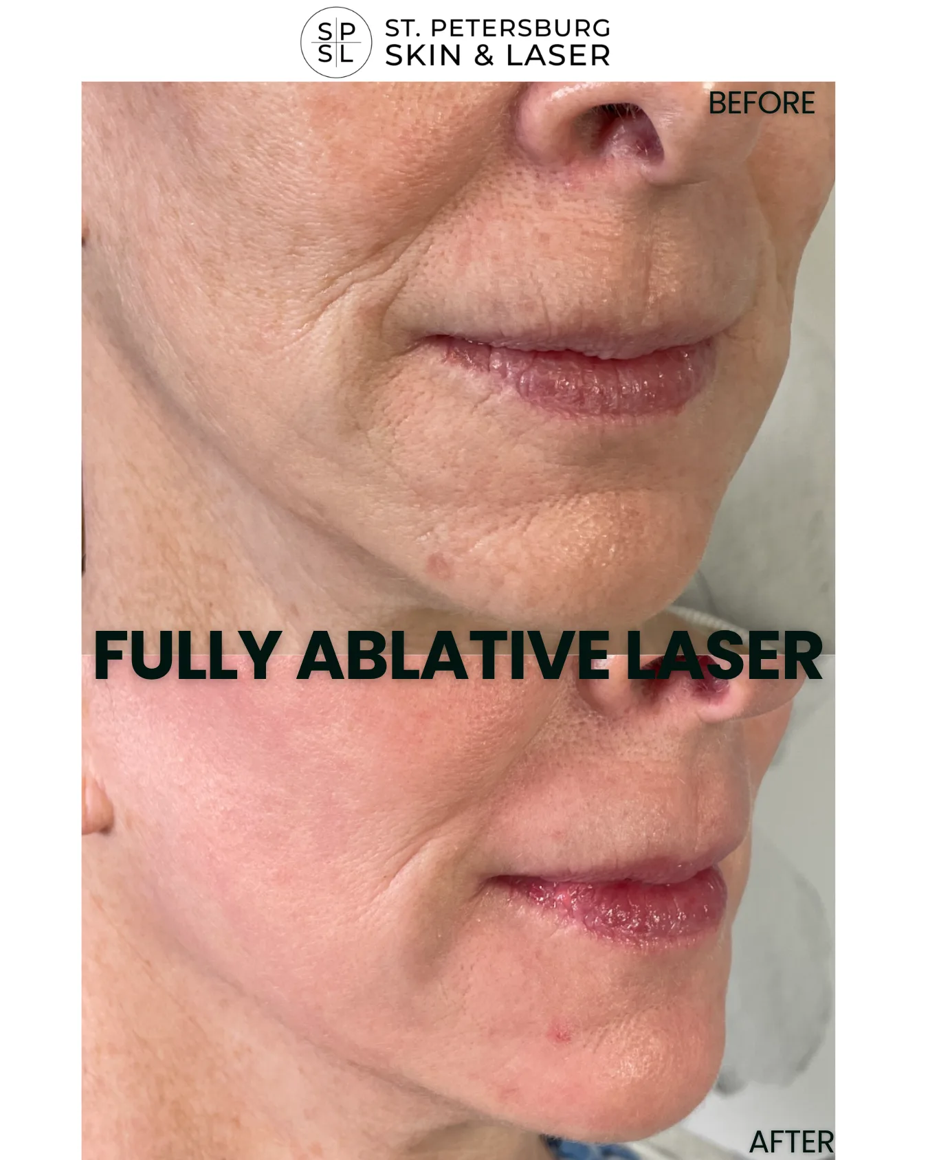 Fully Ablative Laser before and after results
