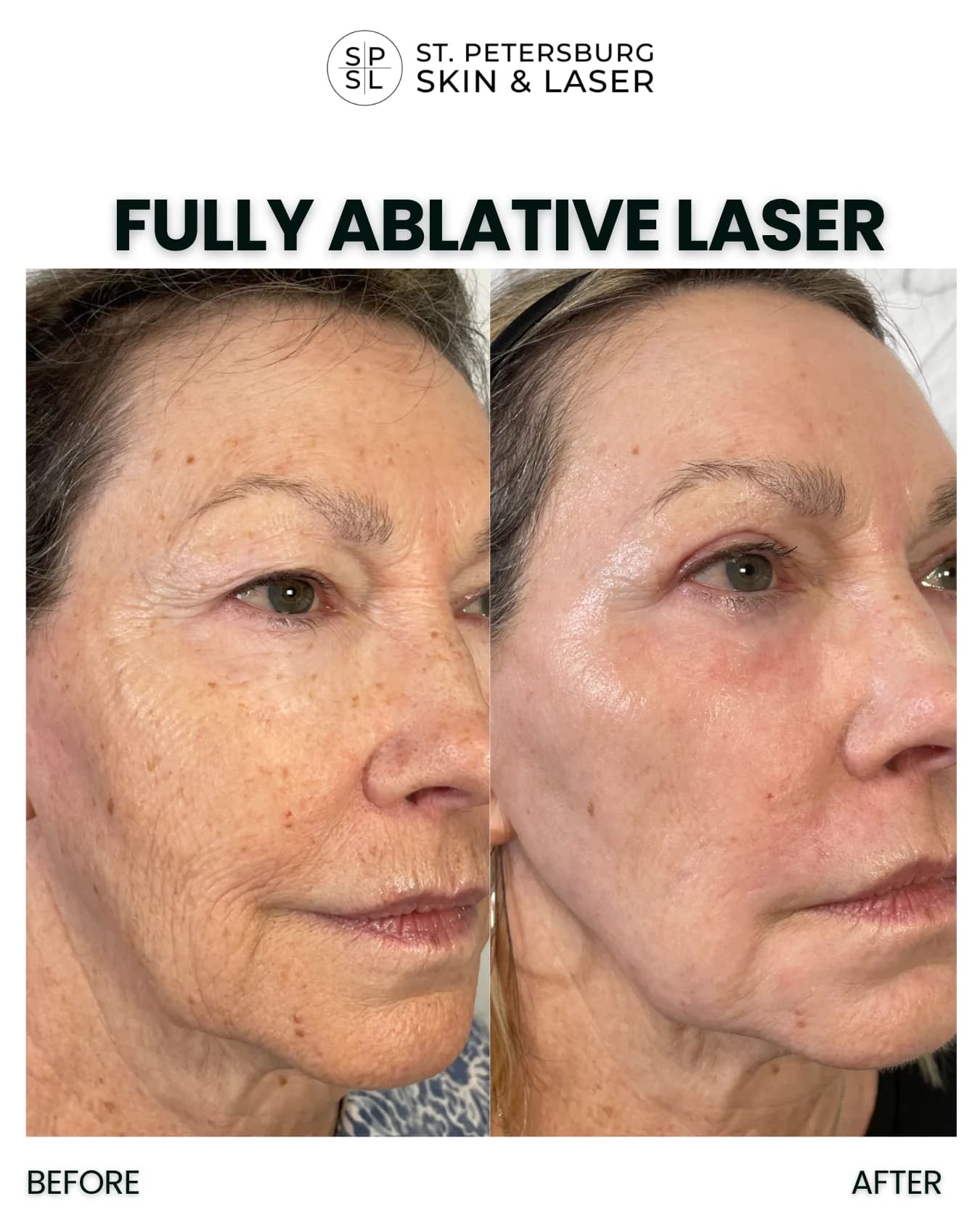 Fully Ablative Laser before and after results