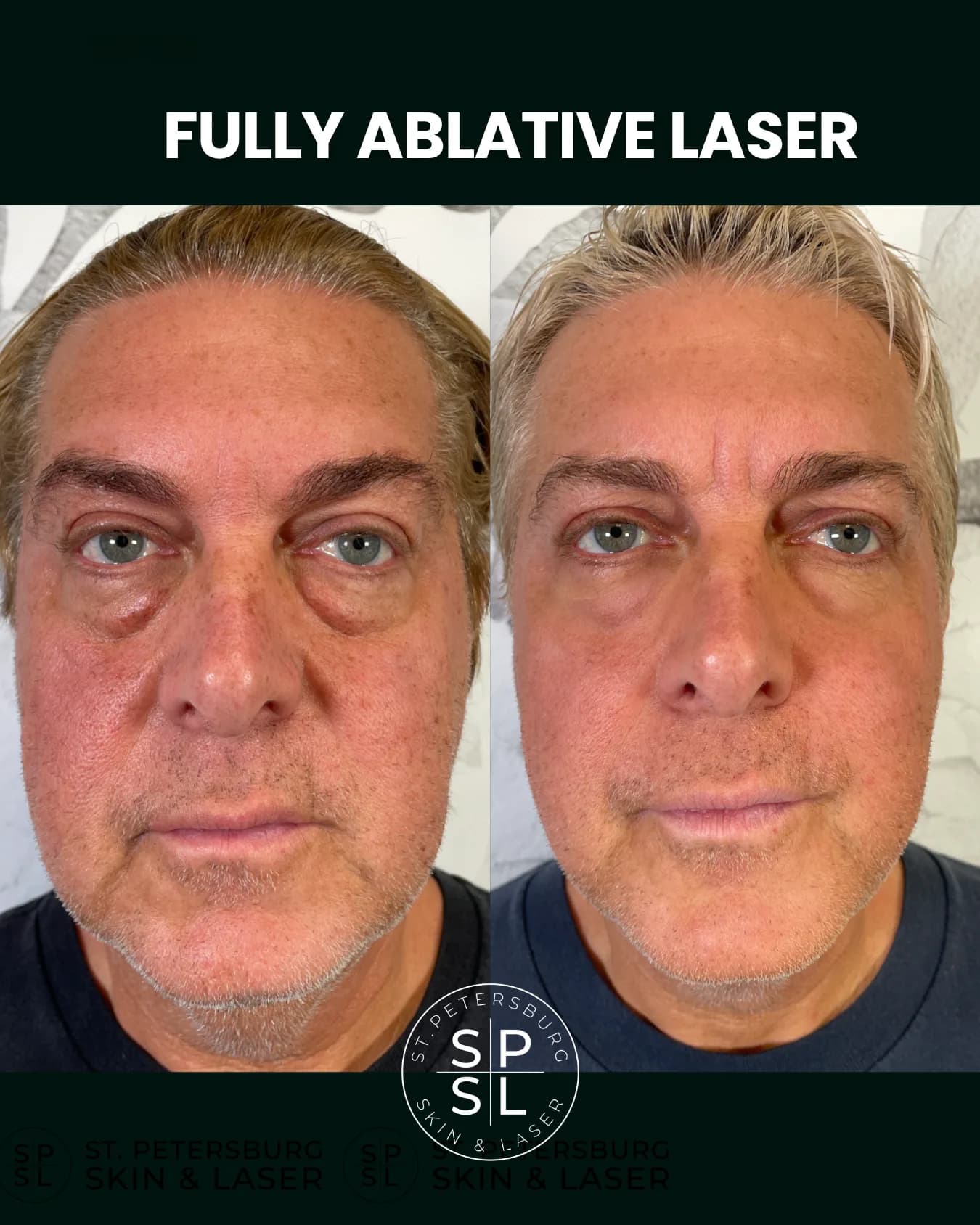 Fully Ablative Laser before and after results