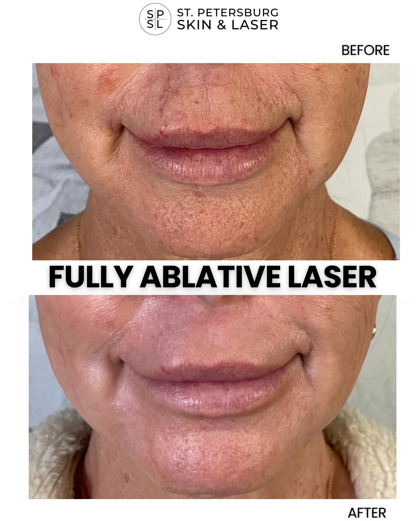 Fully Ablative Laser before and after results