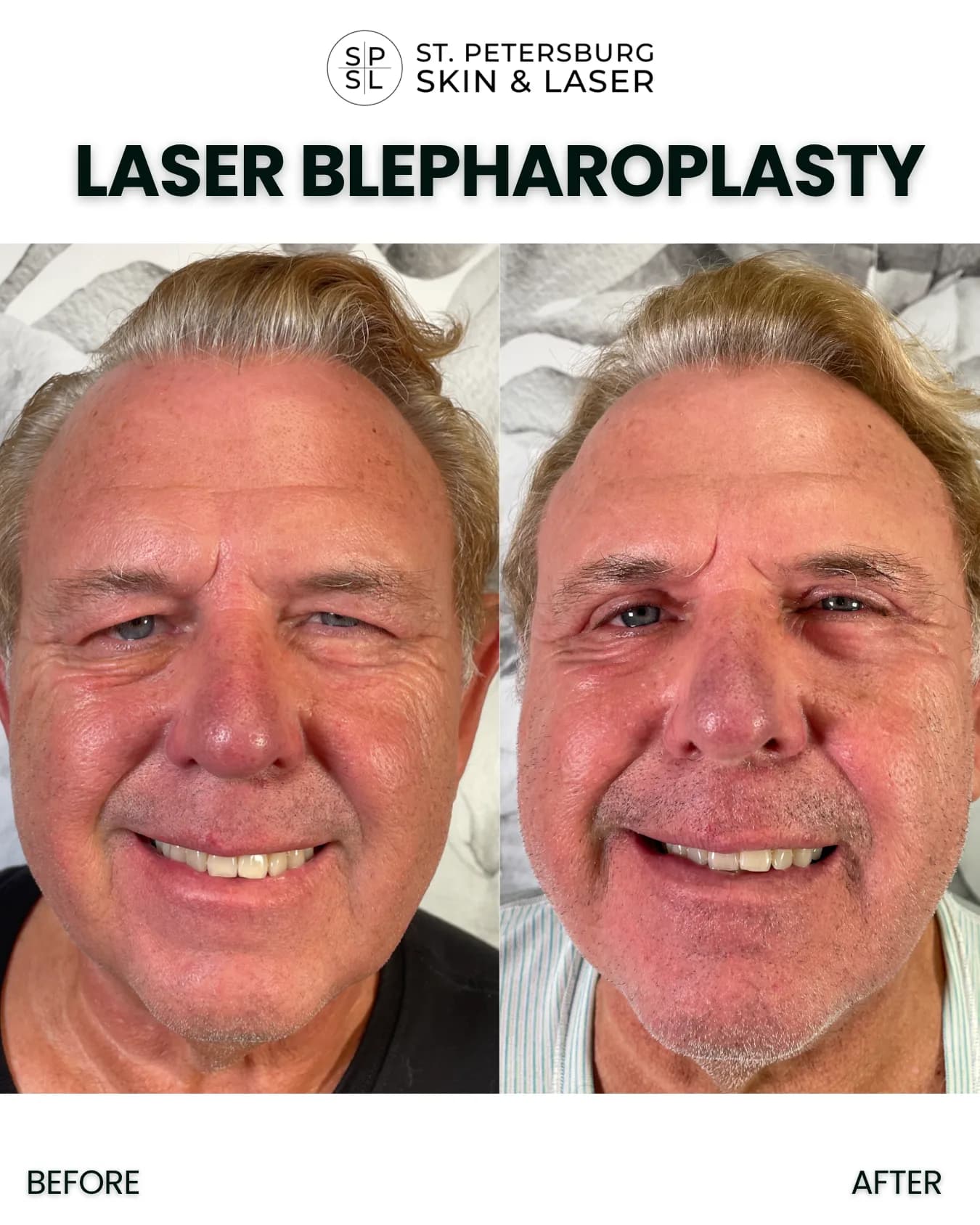 Laser Blepharoplasty before and after results