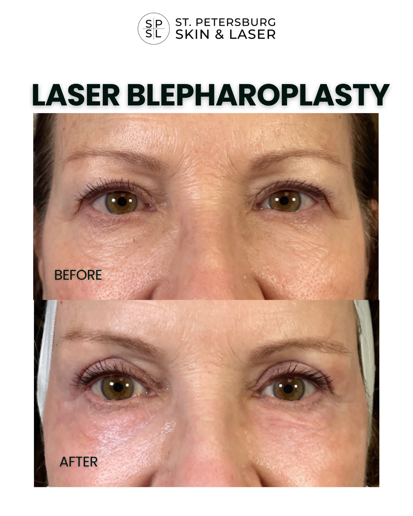 Laser Blepharoplasty before and after results