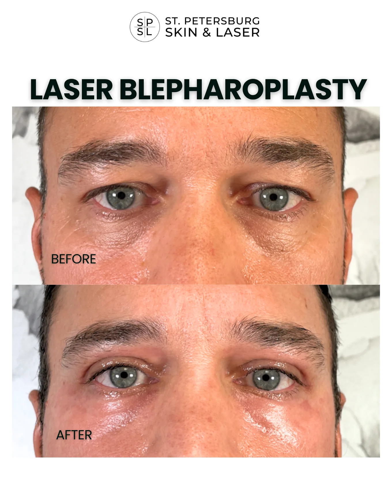 Laser Blepharoplasty before and after results