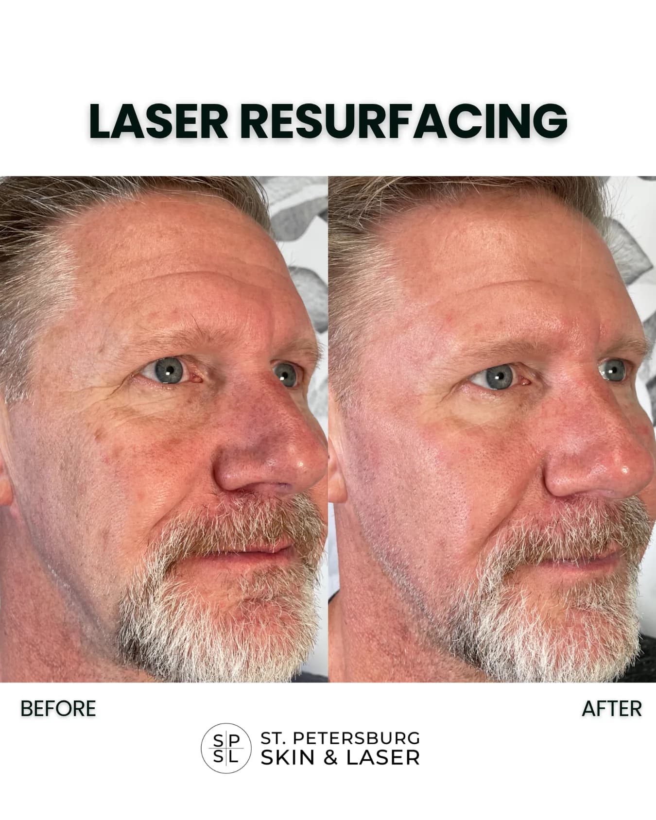 Laser Resurfacing before and after results
