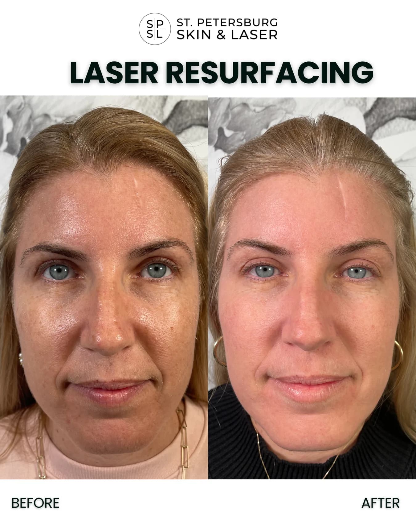 Laser Resurfacing before and after results