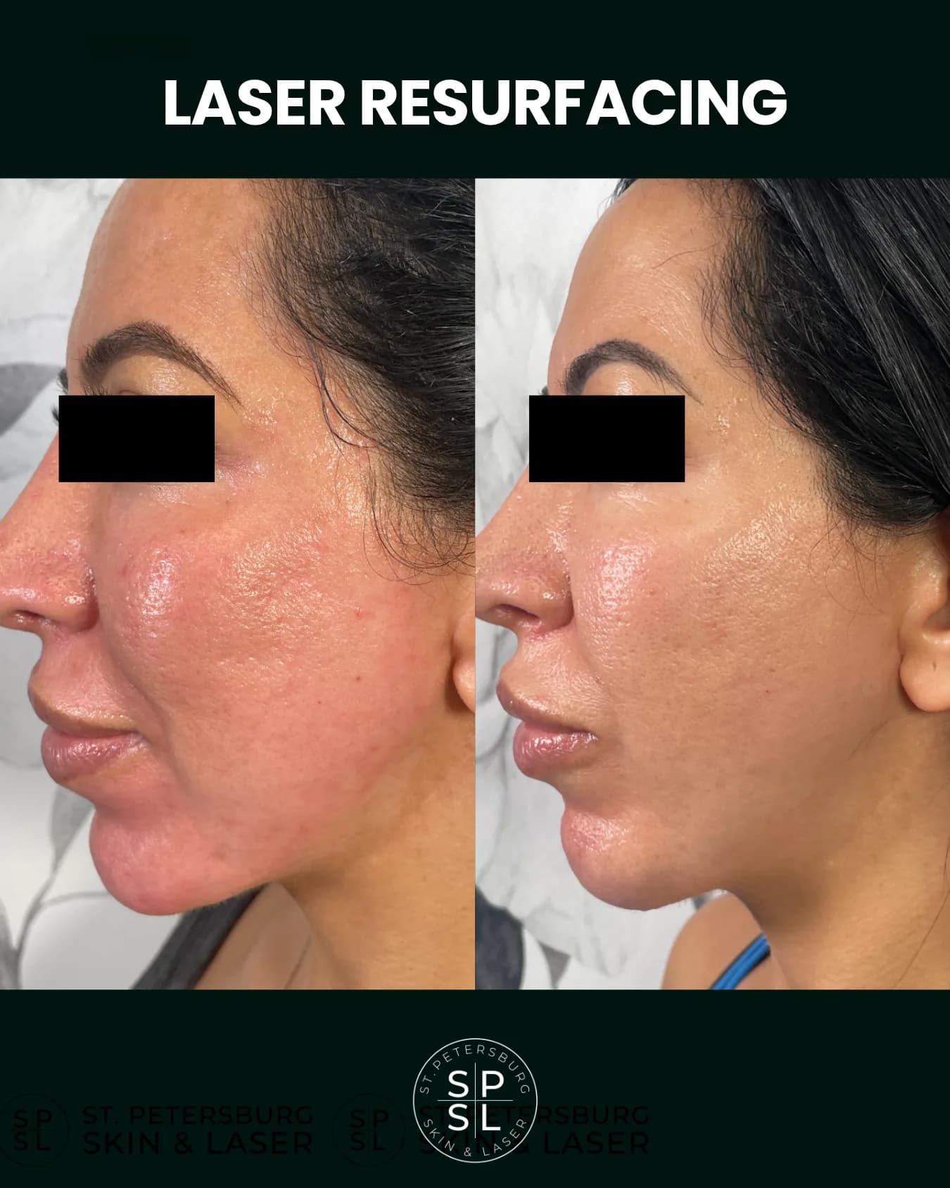 Laser Resurfacing before and after results
