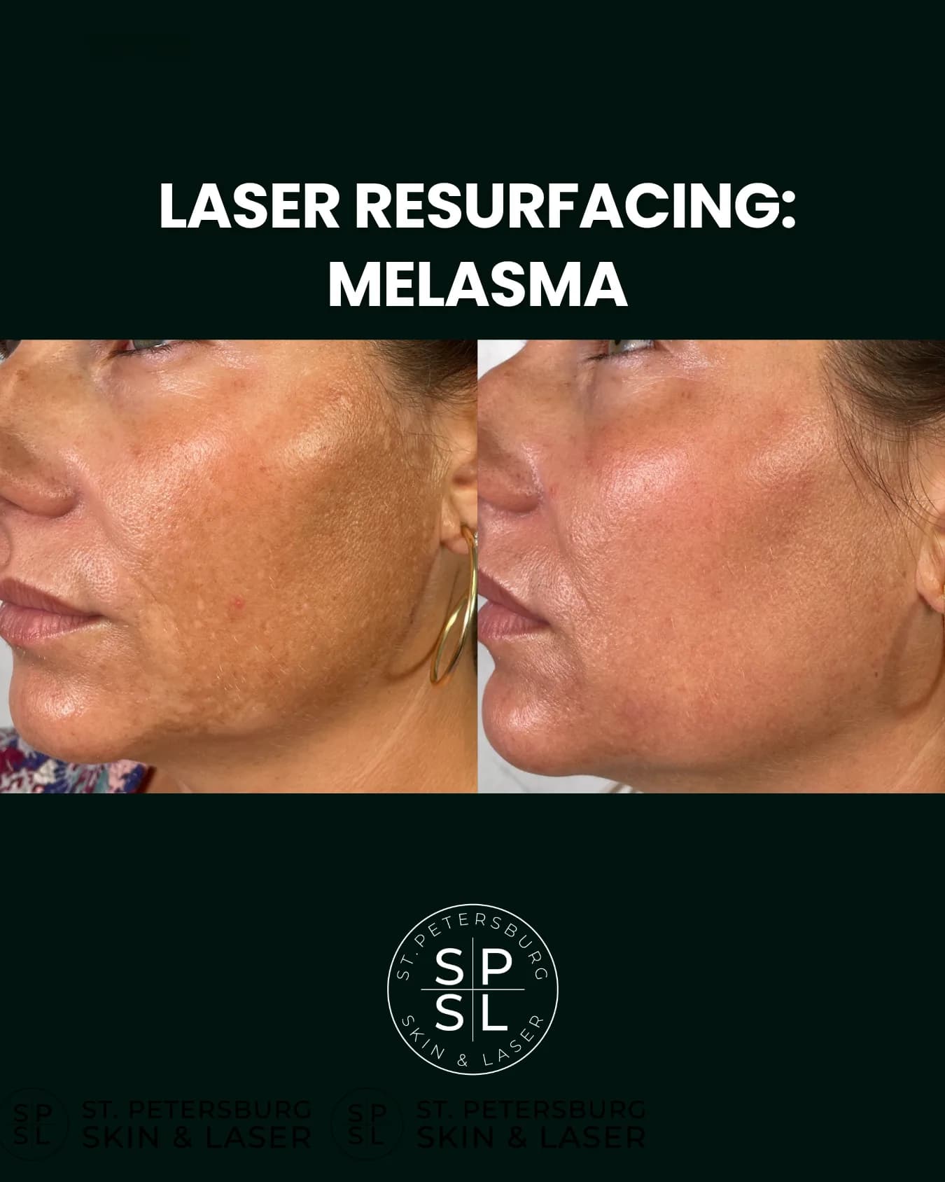 Laser Resurfacing before and after results