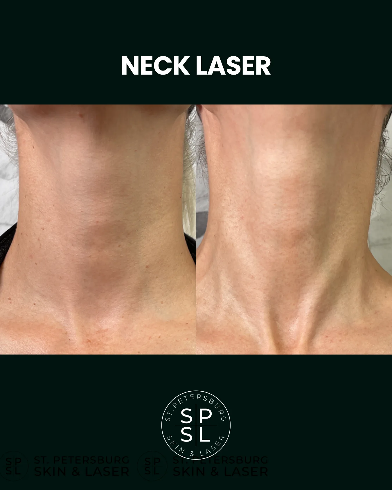 Neck and Chest Laser before and after results