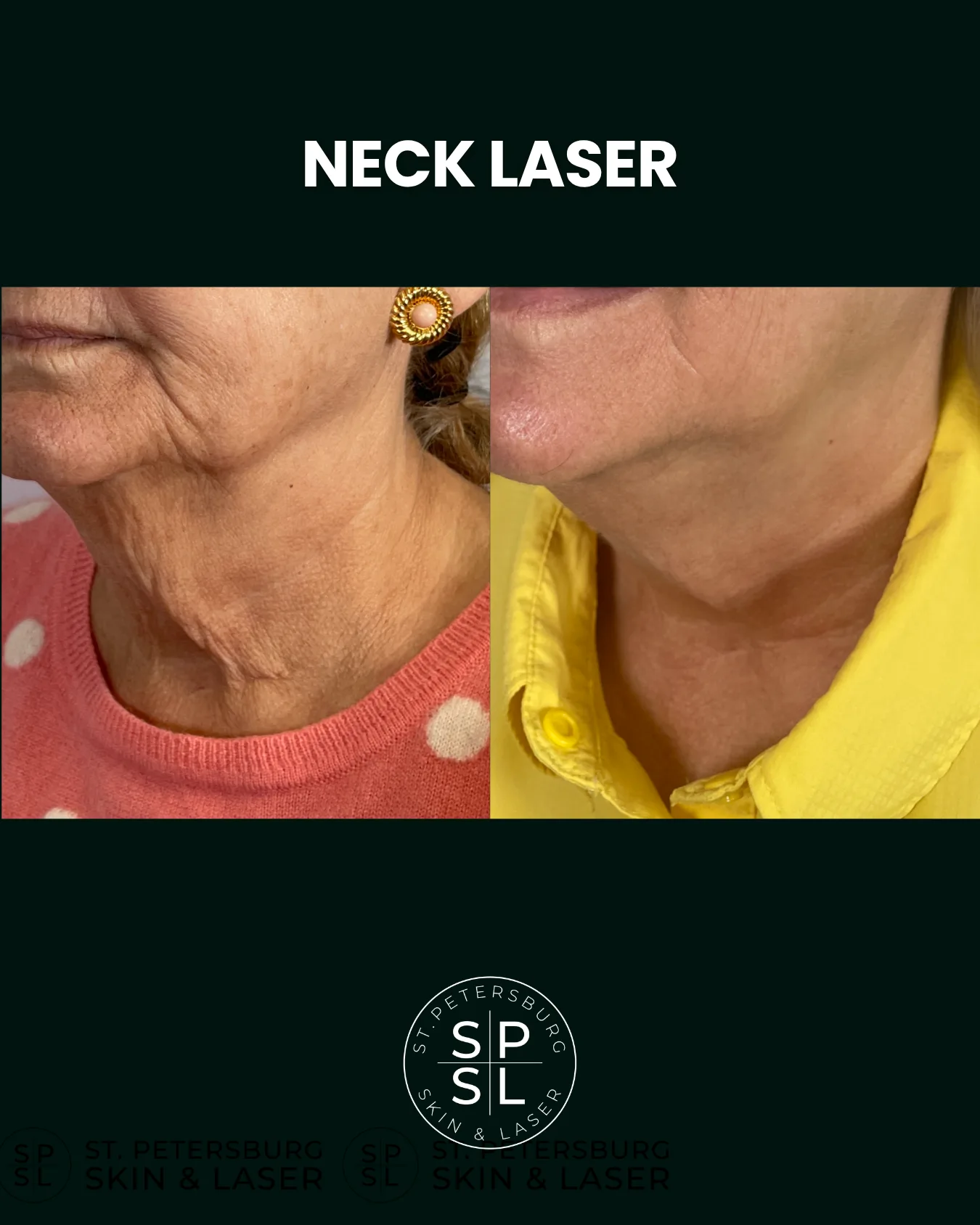 Neck and Chest Laser before and after results
