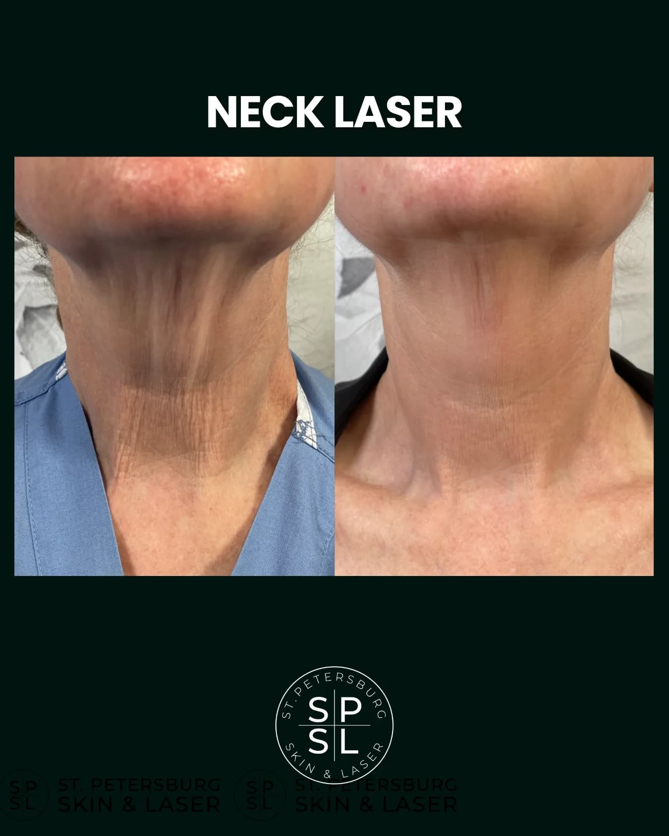 Neck and Chest Laser before and after results