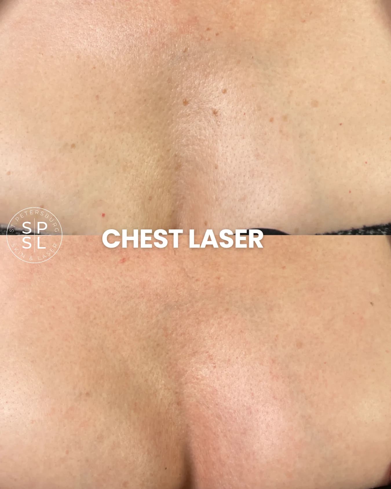 Neck and Chest Laser before and after results