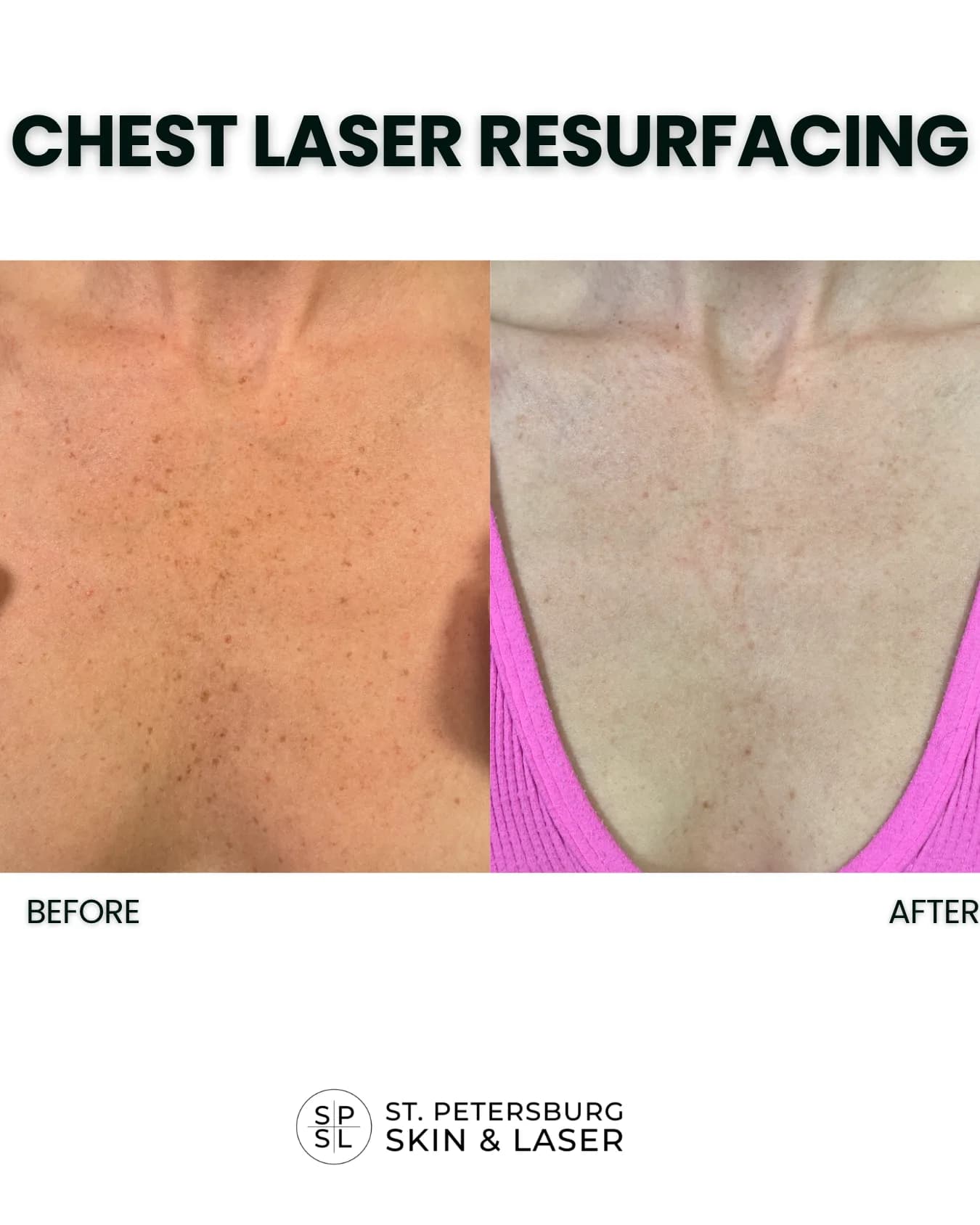 Neck and Chest Laser before and after results