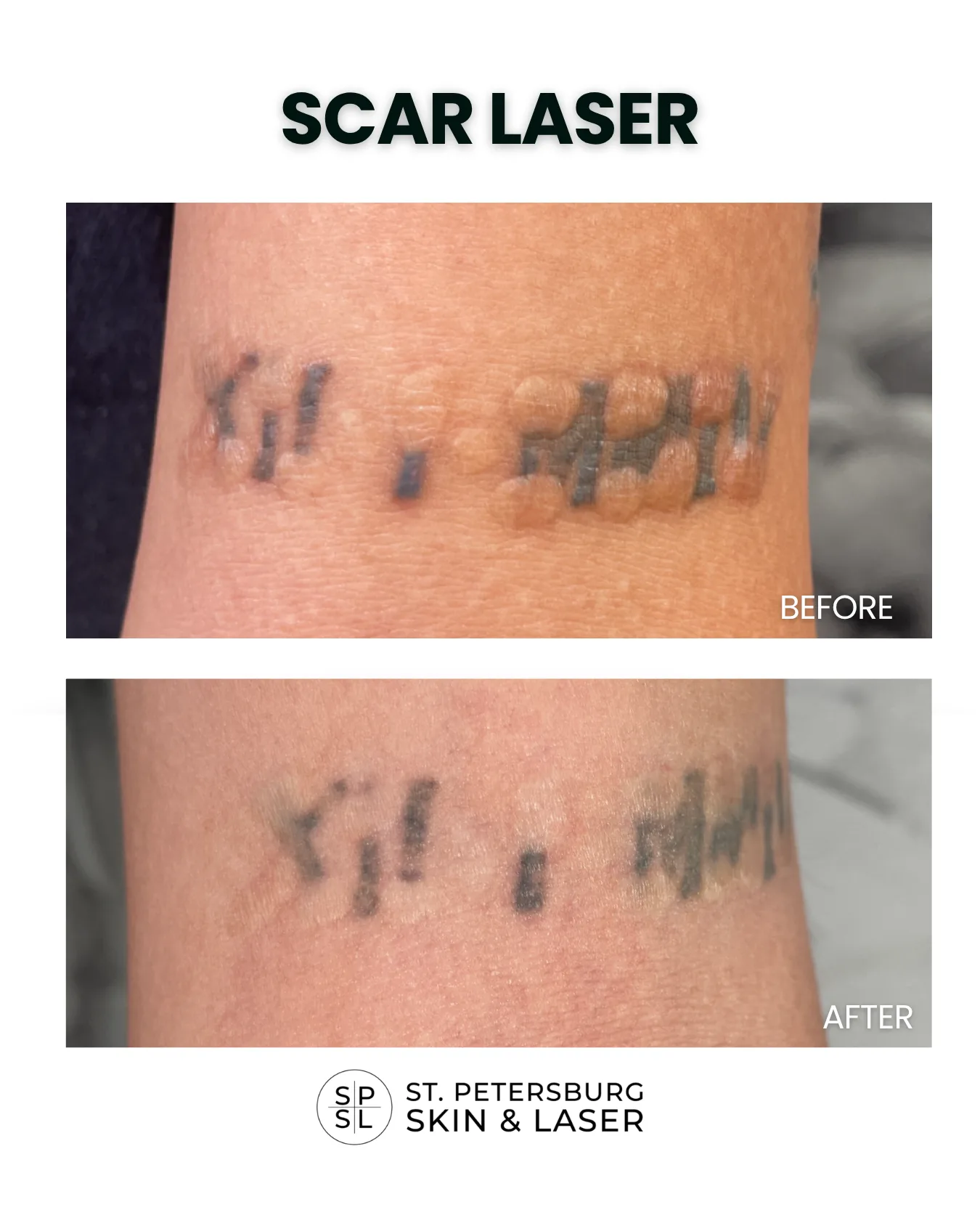 Scar Laser before and after results