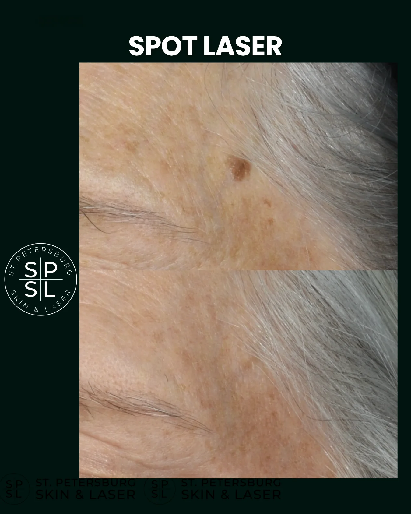 Spot Laser before and after results