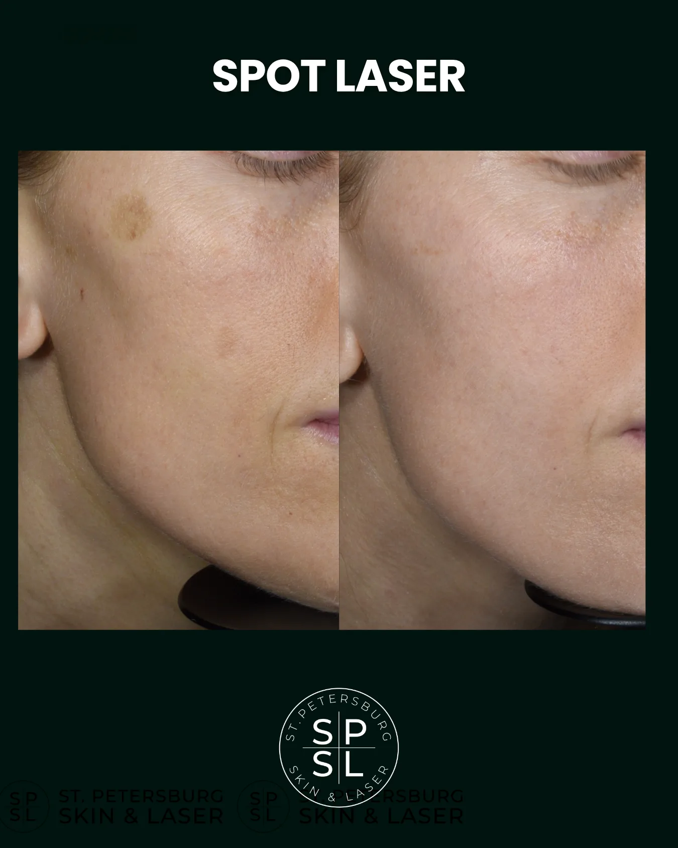 BBL treatment before and after results
