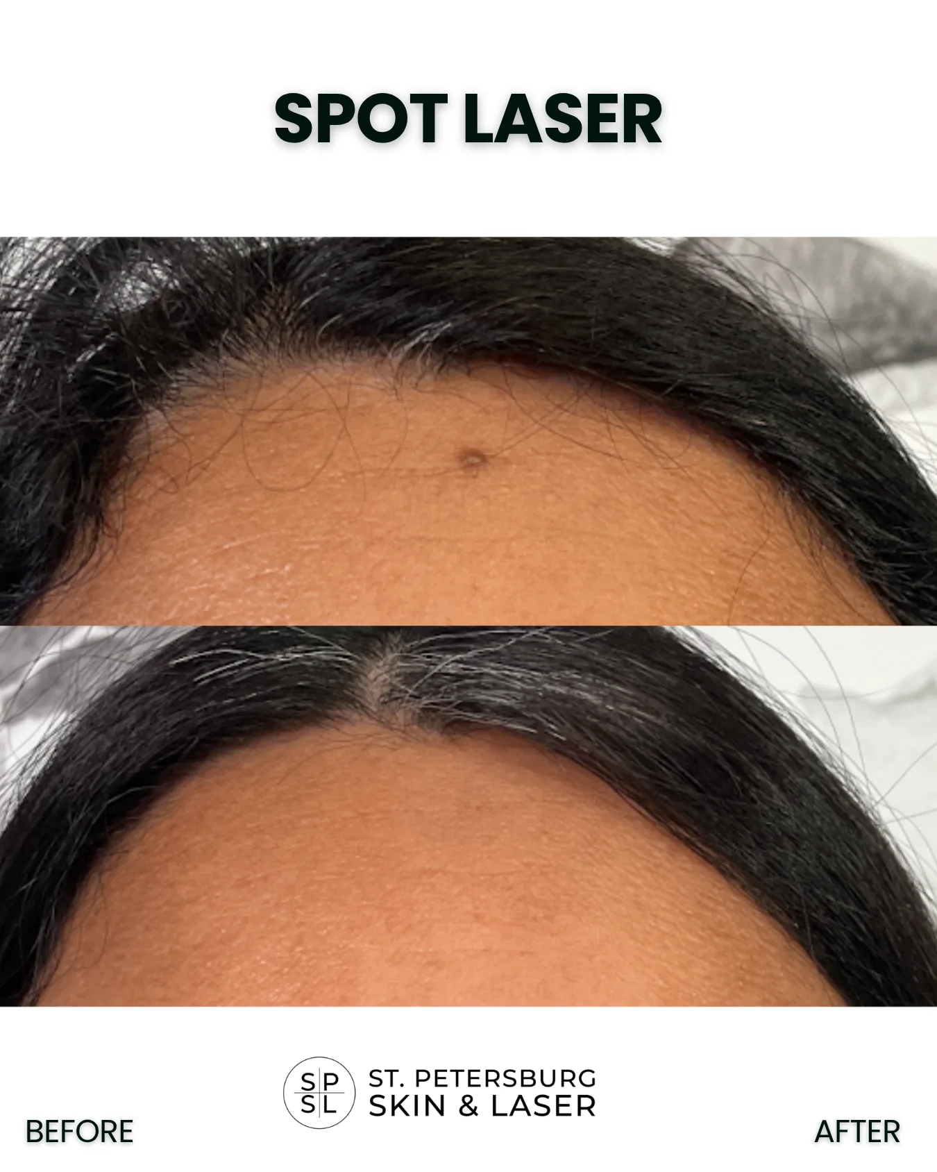 Spot Laser before and after results