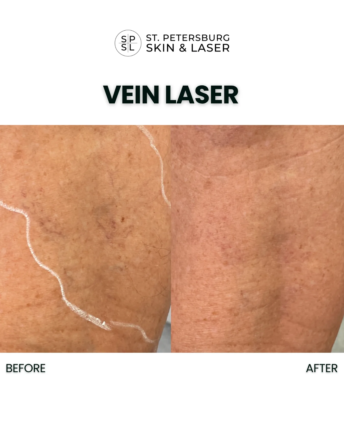 Vascular Laser before and after results