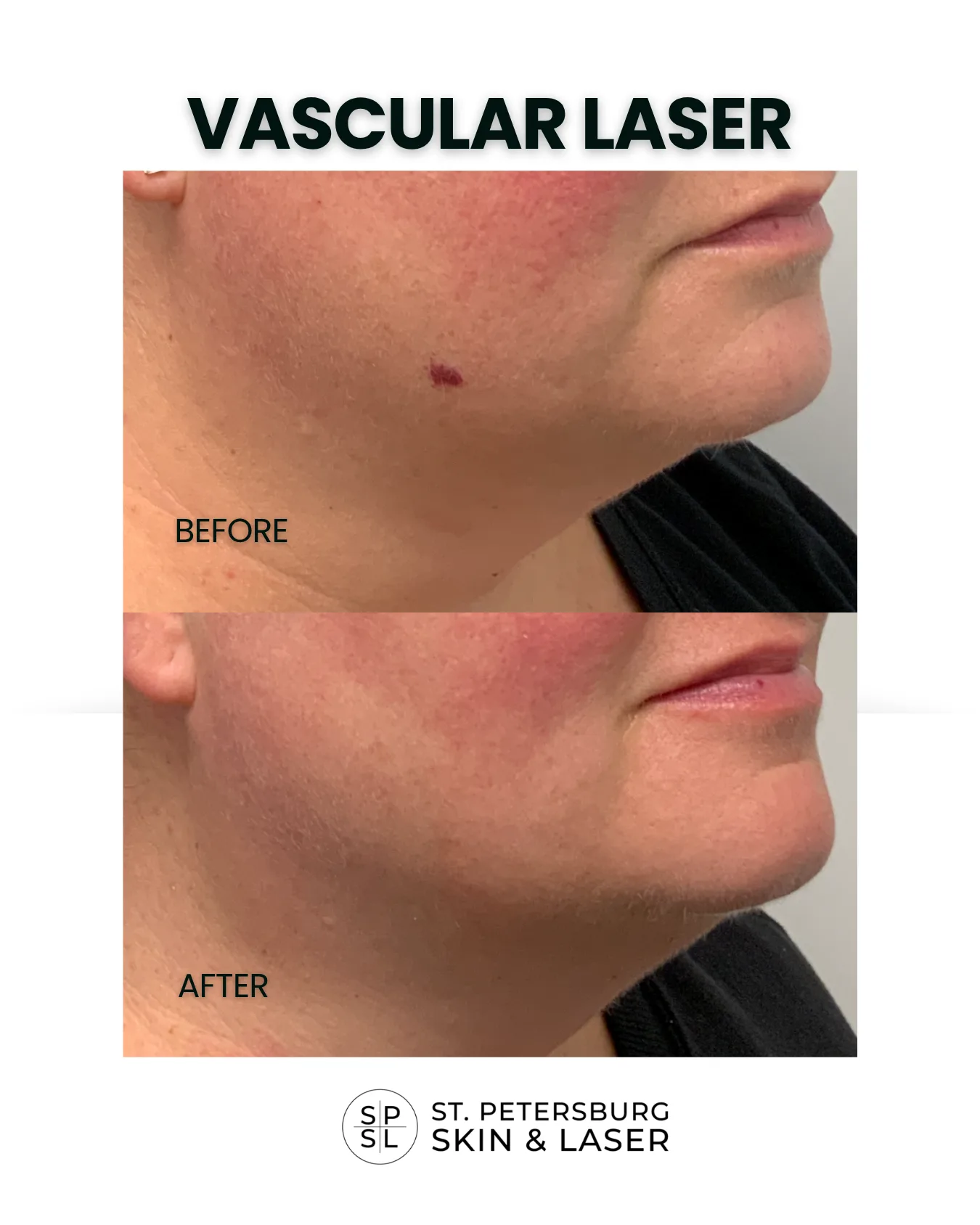 Vascular Laser before and after results