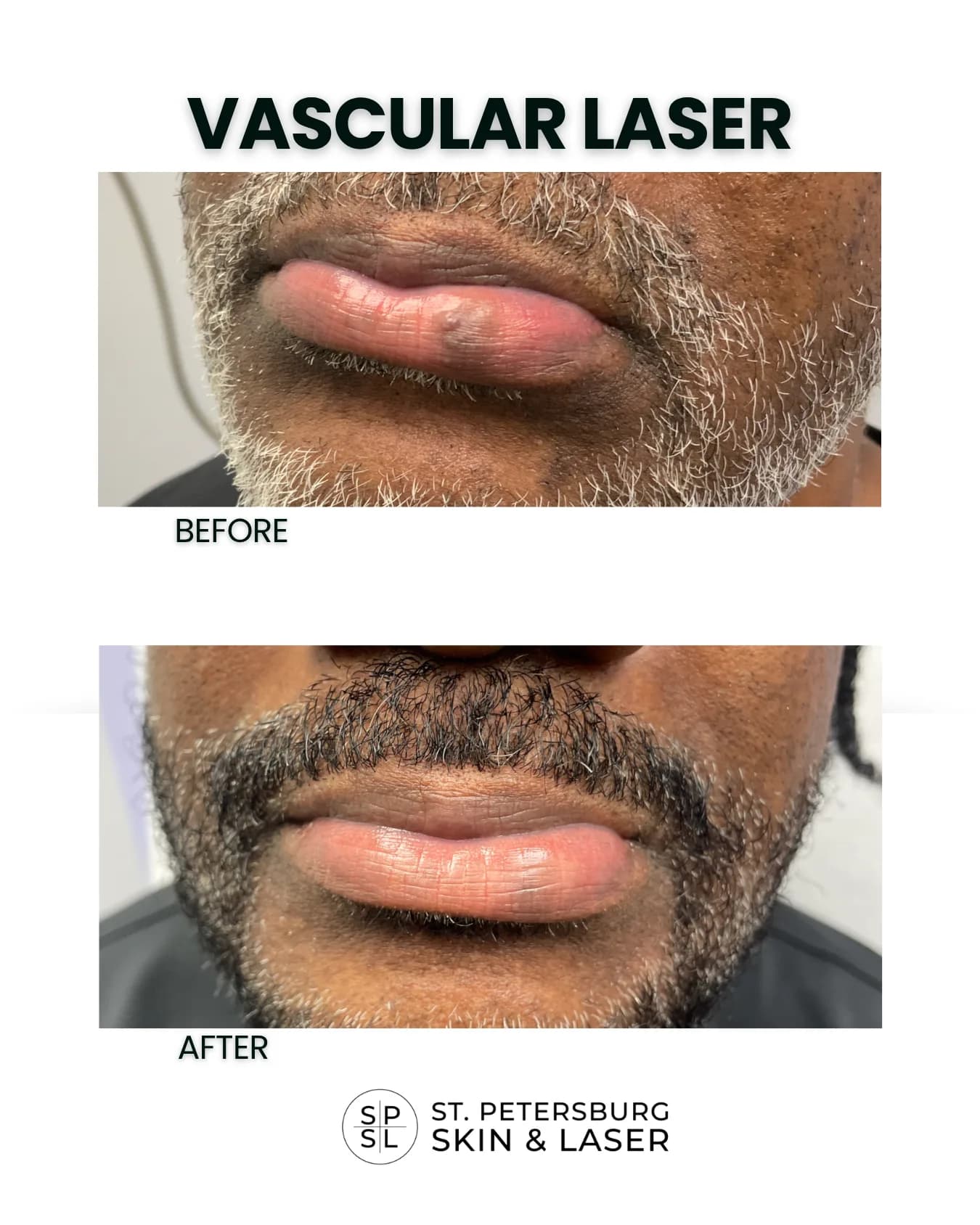 Vascular Laser before and after results
