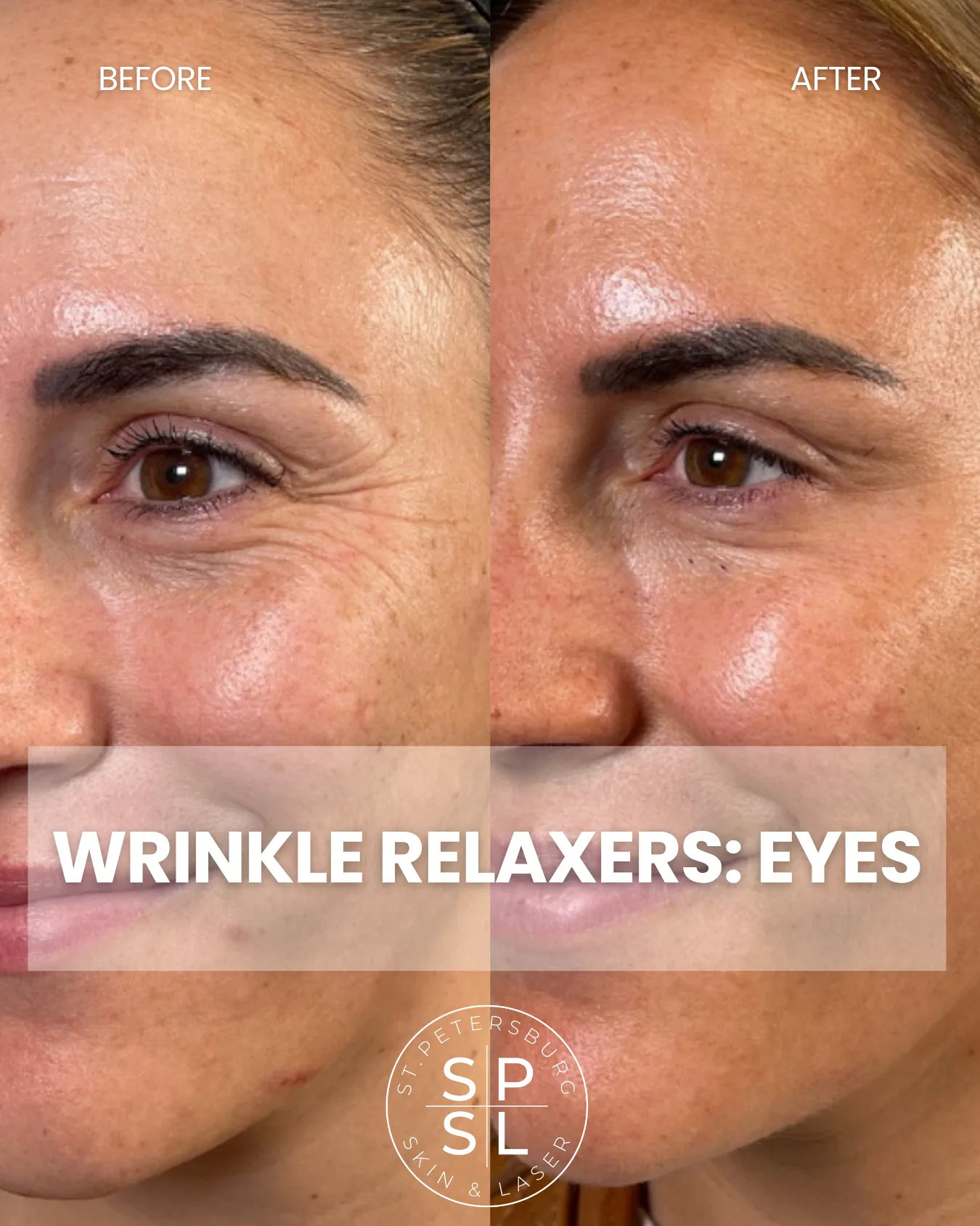 Wrinkle Relaxer Results Before