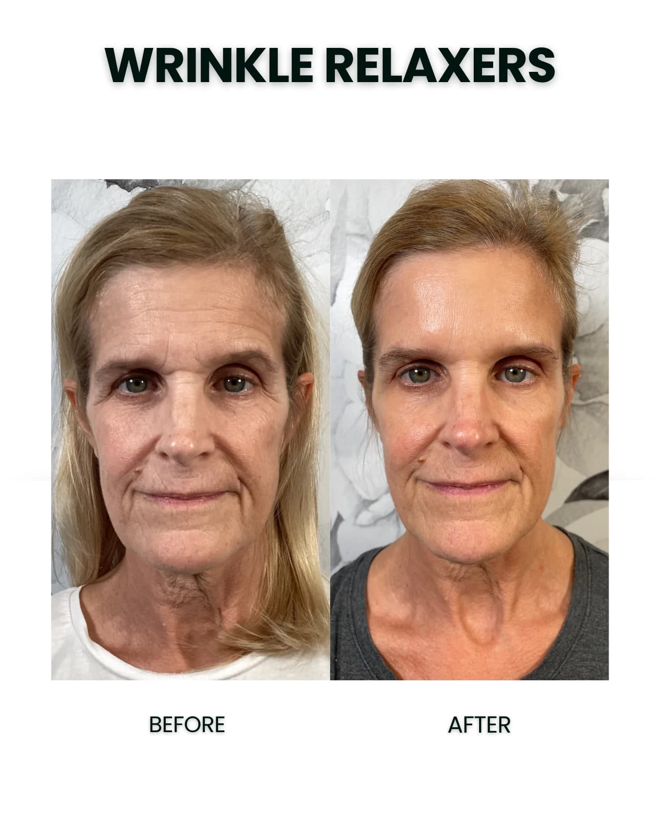 Wrinkle Relaxer Results After