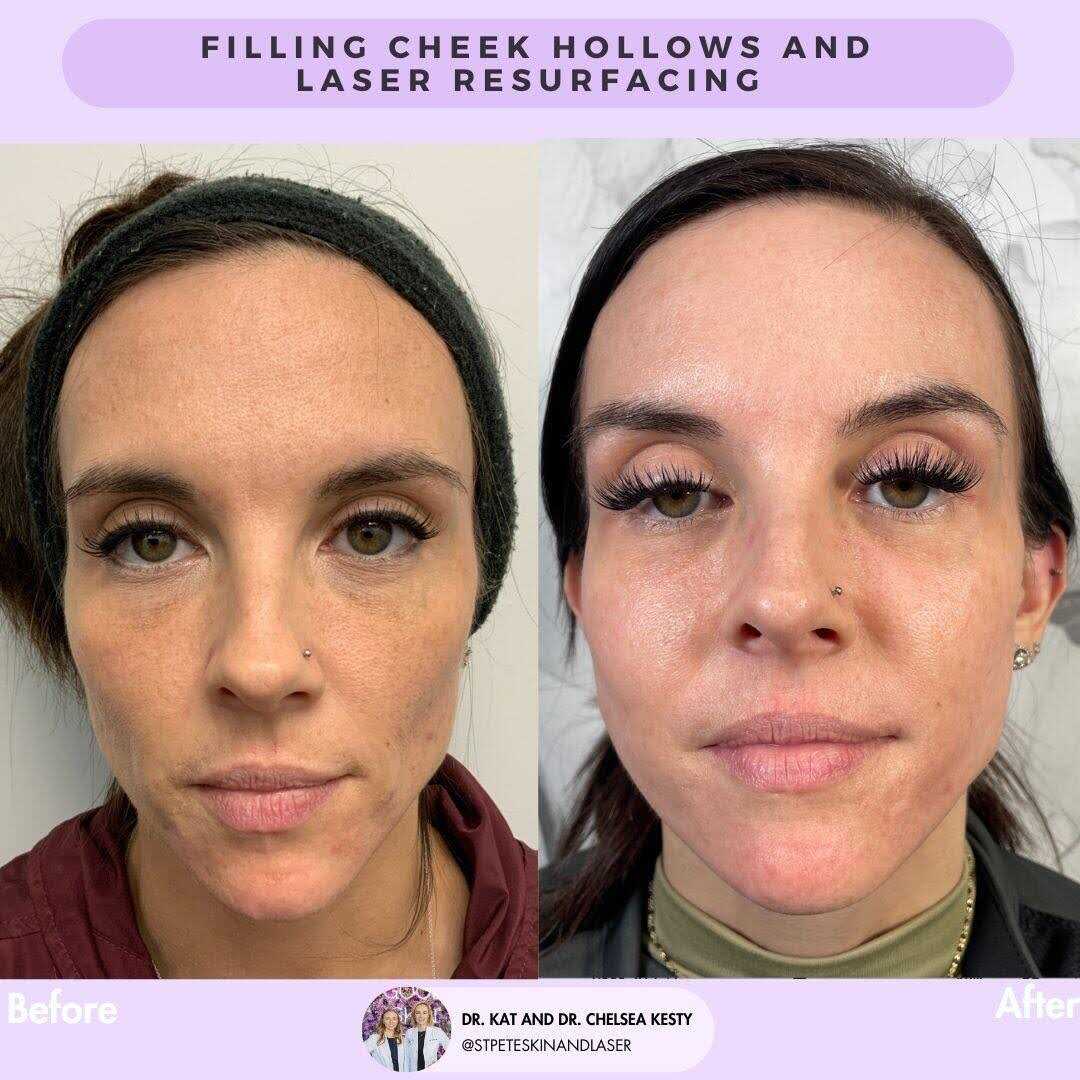 Dermal filler treatment results