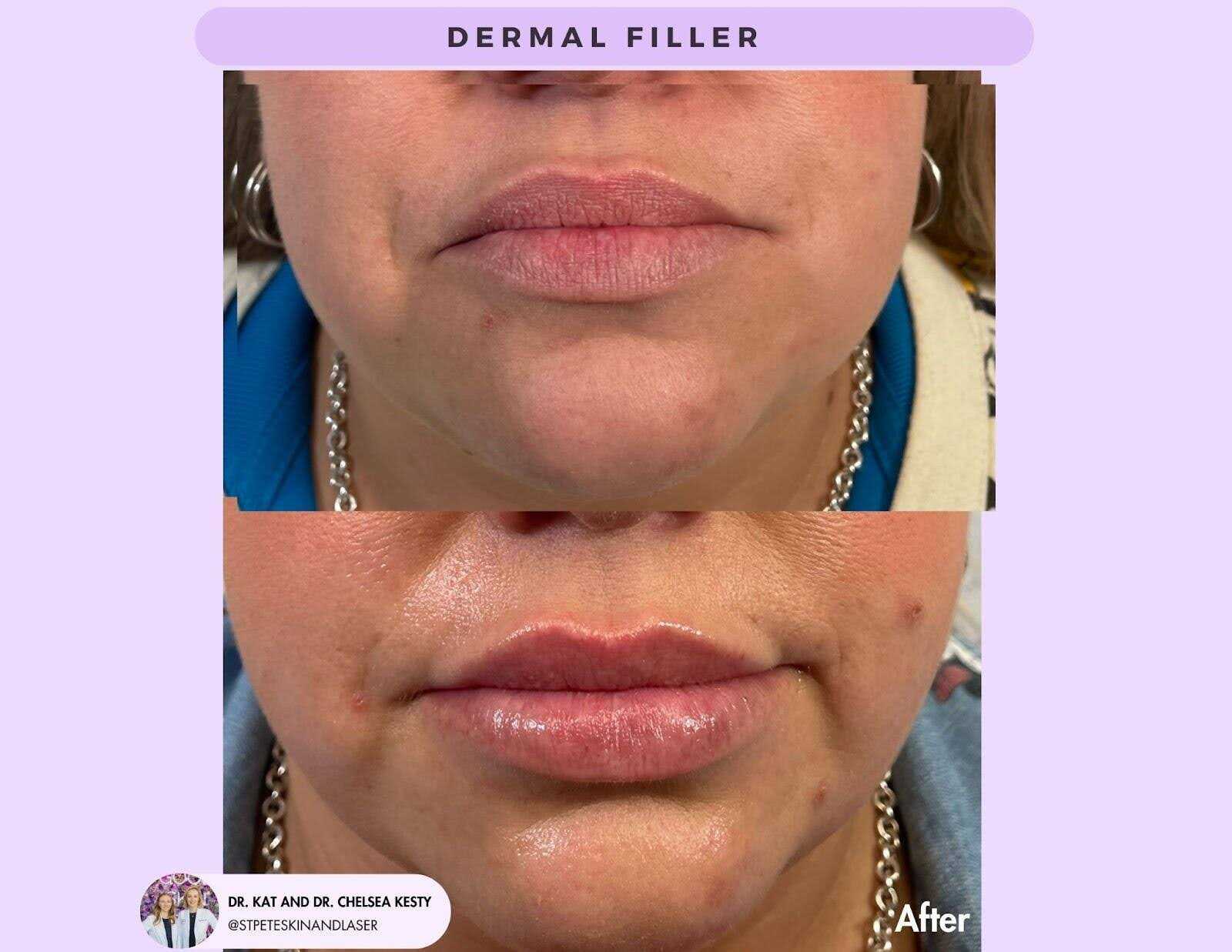 Dermal filler before and after results