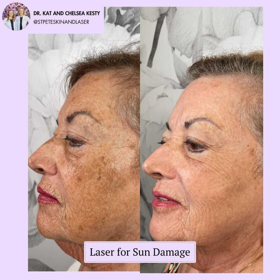 IPL Treatment Results