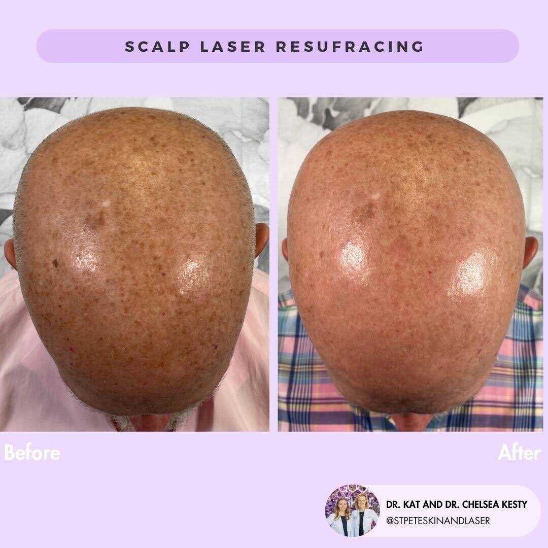 Non-ablative laser treatment results