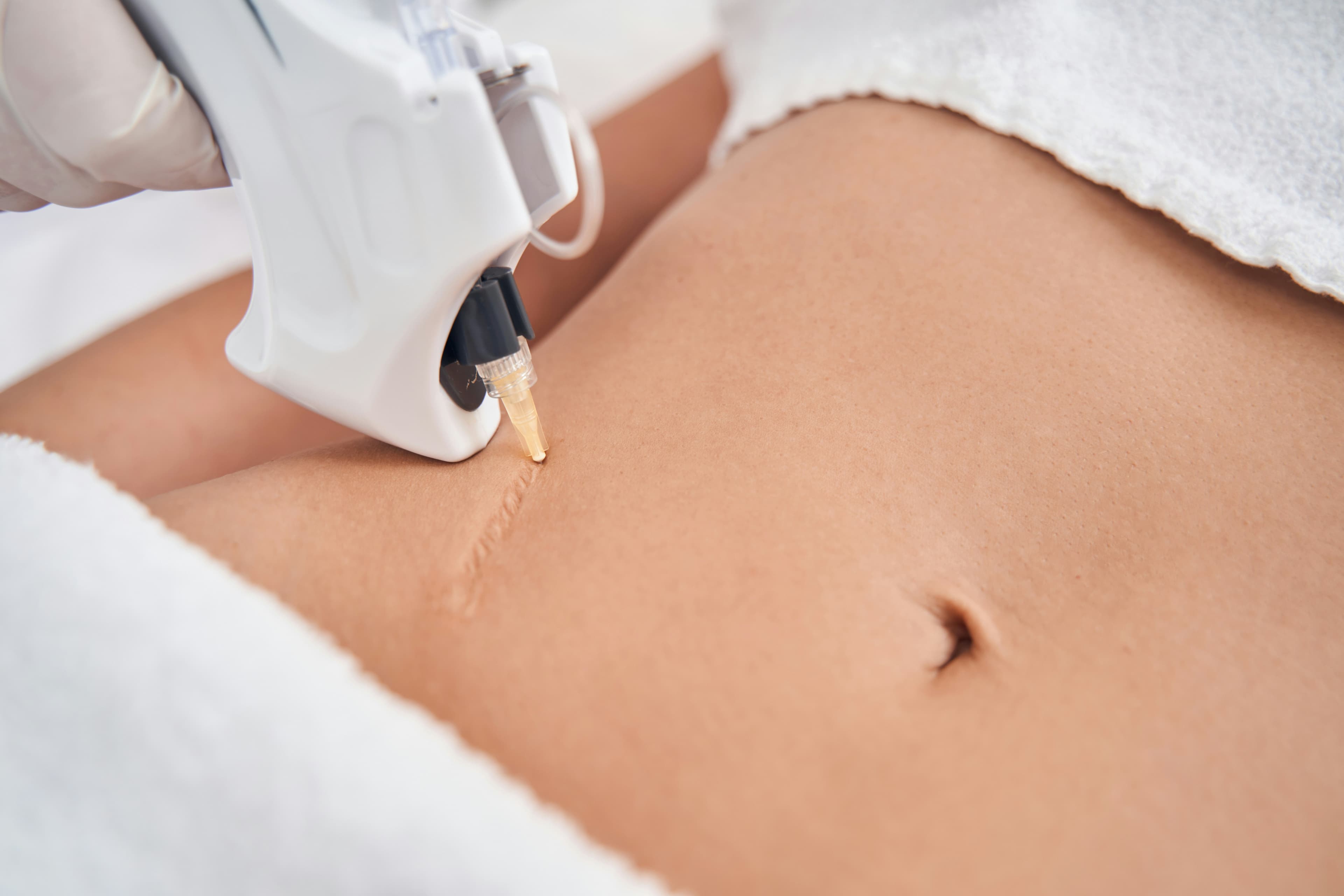 Professional medical image showcasing skin texture and scar treatment area for laser therapy