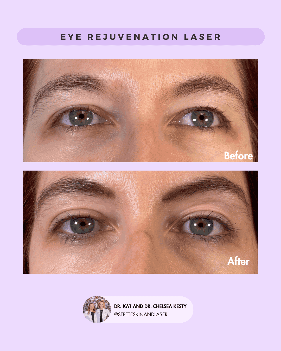 Eye Rejuvenation before and after results
