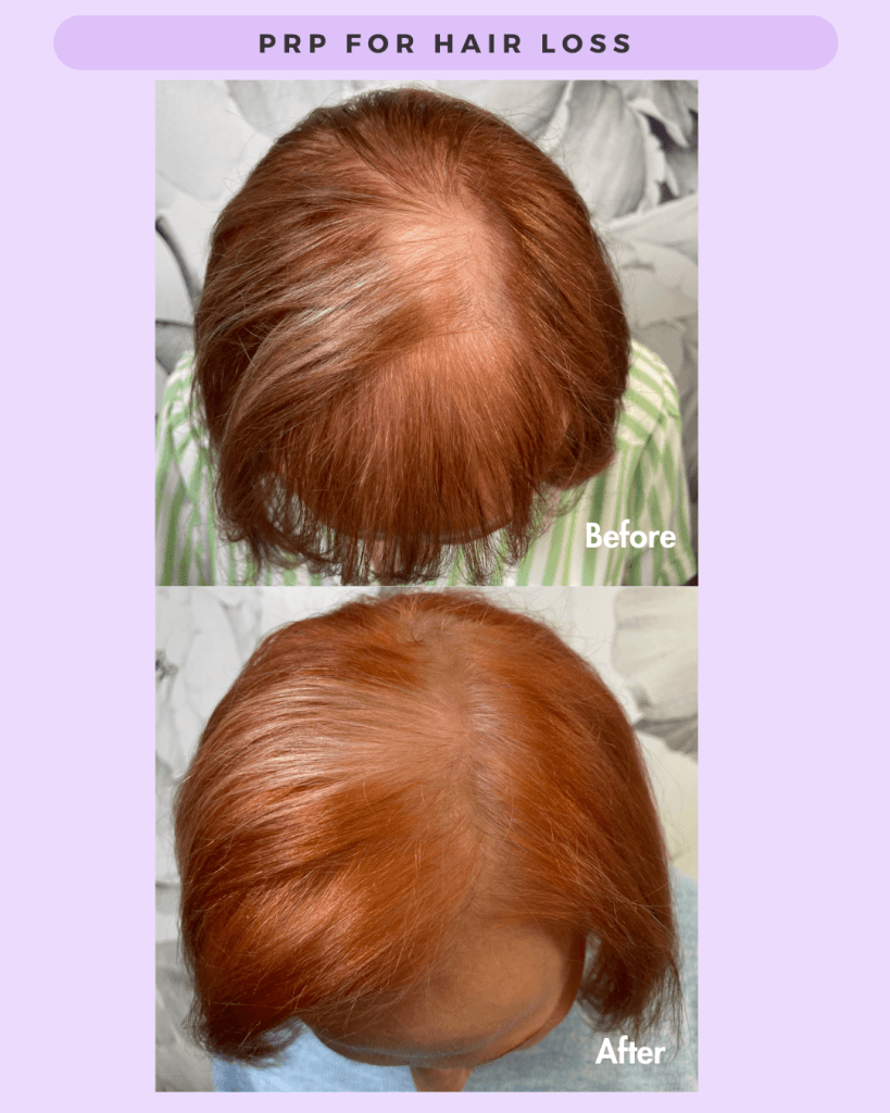 Other Cosmetic Procedures before and after results