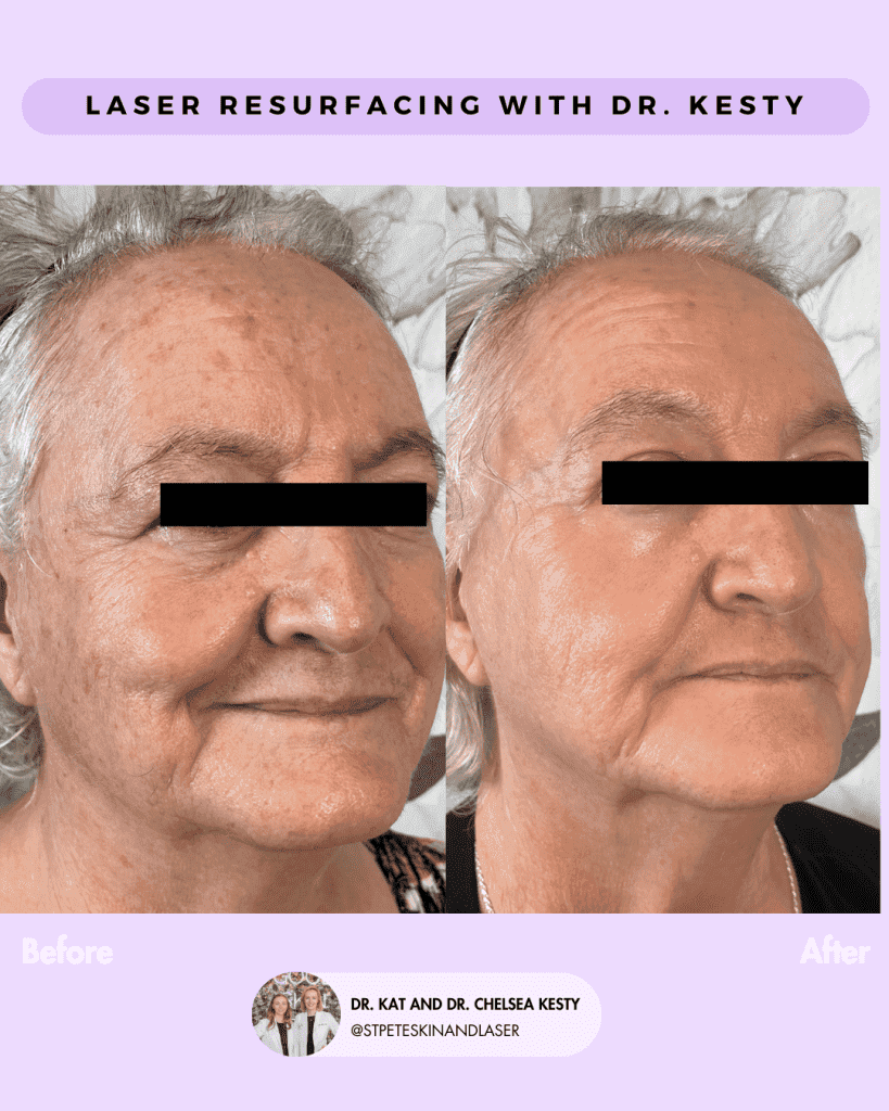 Laser Resurfacing before and after results