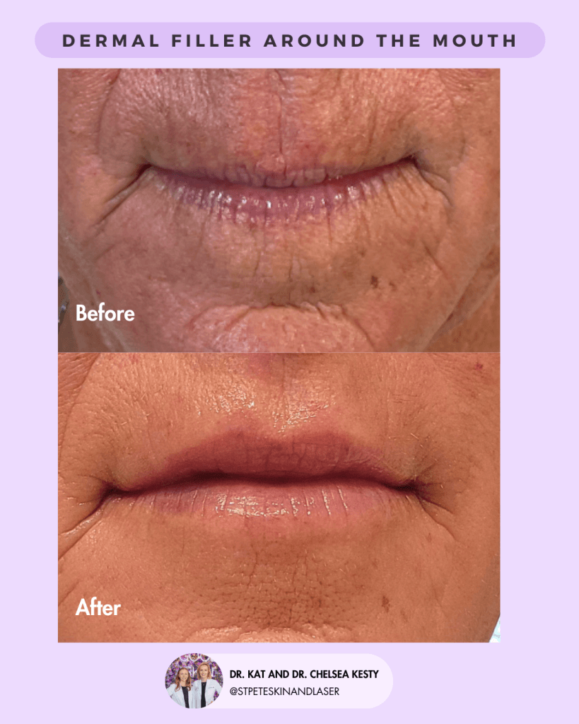 Dermal Fillers before and after results